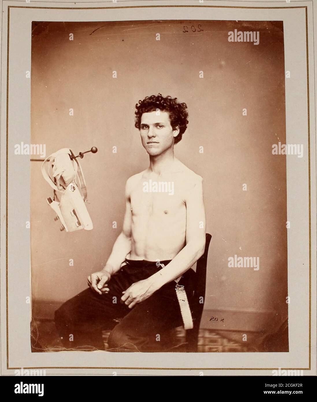 . Fotografías de casos y especímenes quirúrgicos. D fractura en tercio superior del húmero izquierdo. Siete horas después de la recepción de laslesiones, mientras que en el campo, el cirujano Sylvester H. Sawyers, 36th Iowa Vol-unteers, excitar el tercio superior del eje, quitando cuatro y un halfinch junto con la cabeza del húmero, a través de una incisionlinear entre los músculos bíceps y deltoides. La herida sanó bien, con flexión del antebrazo afectada por la contracción del extensor del tríceps lesionado.la herida a través de la escápula aún estaba abierta, y el brazo inútil para laborcuando el hombre fue dado de alta el servicio. H Foto de stock