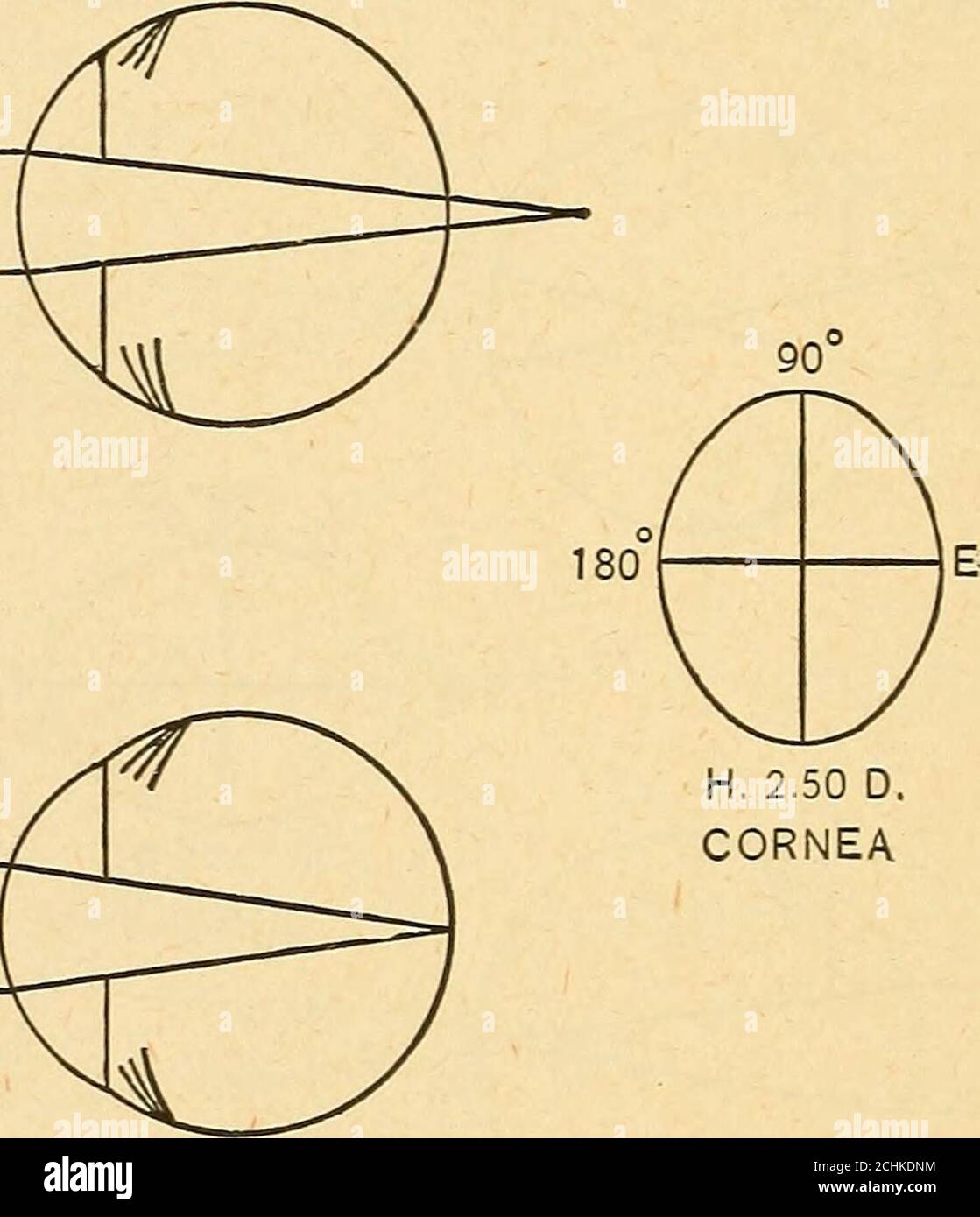 La refracción del ojo; incluyendo un tratado completo en oftalmometría; es  que es solo .25 D., o puede estar ausente. Una vez más, puede llegar a 0,75  D., o 1 D.,