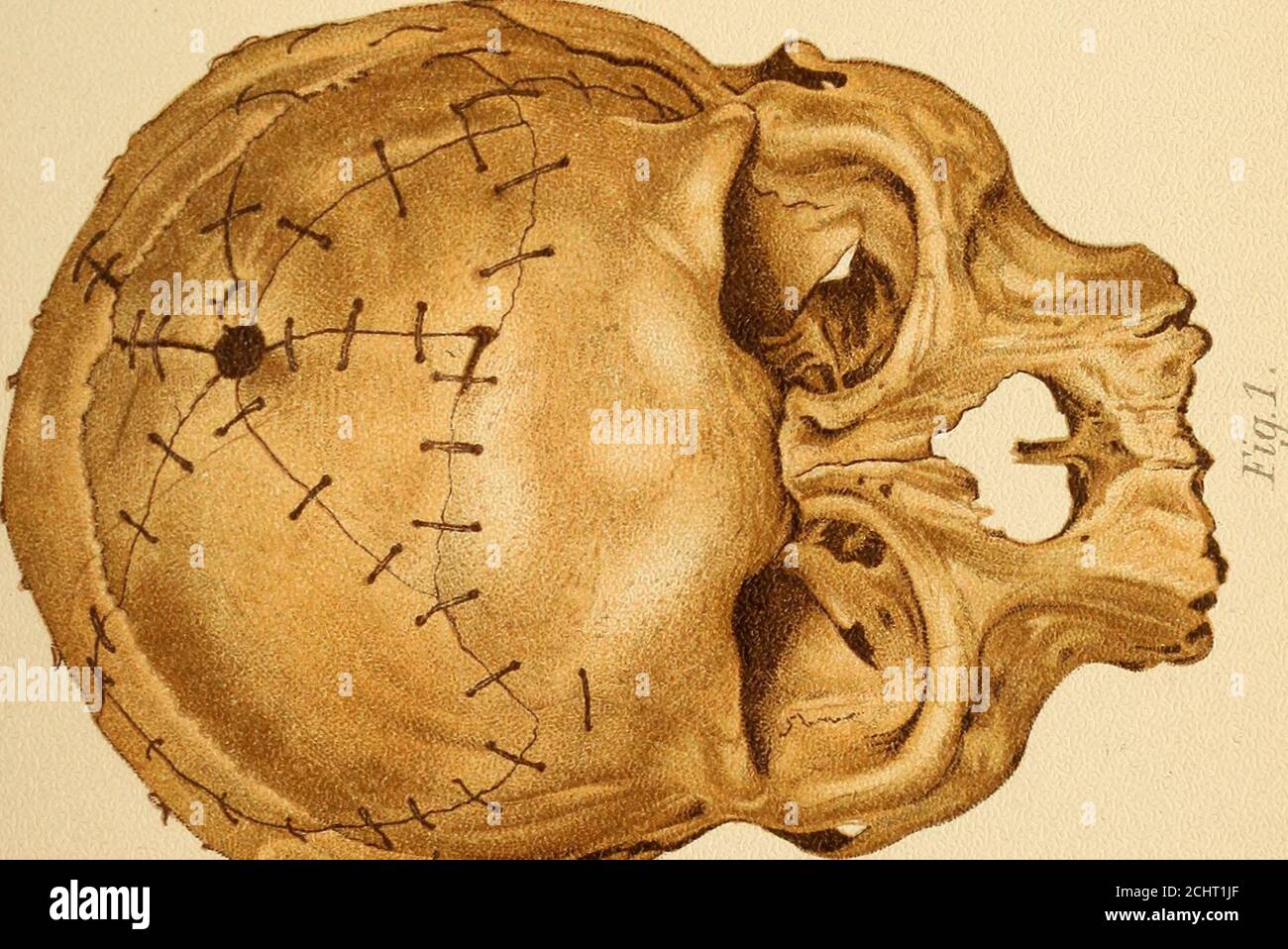 Atlas Y Epitome De Traumatica V V Jl V Iz Fracturas Del Craneo En Aras De La Integridad Se Debe Mediralque Una Solucion De Continuidad En La Boveda Del Craneo