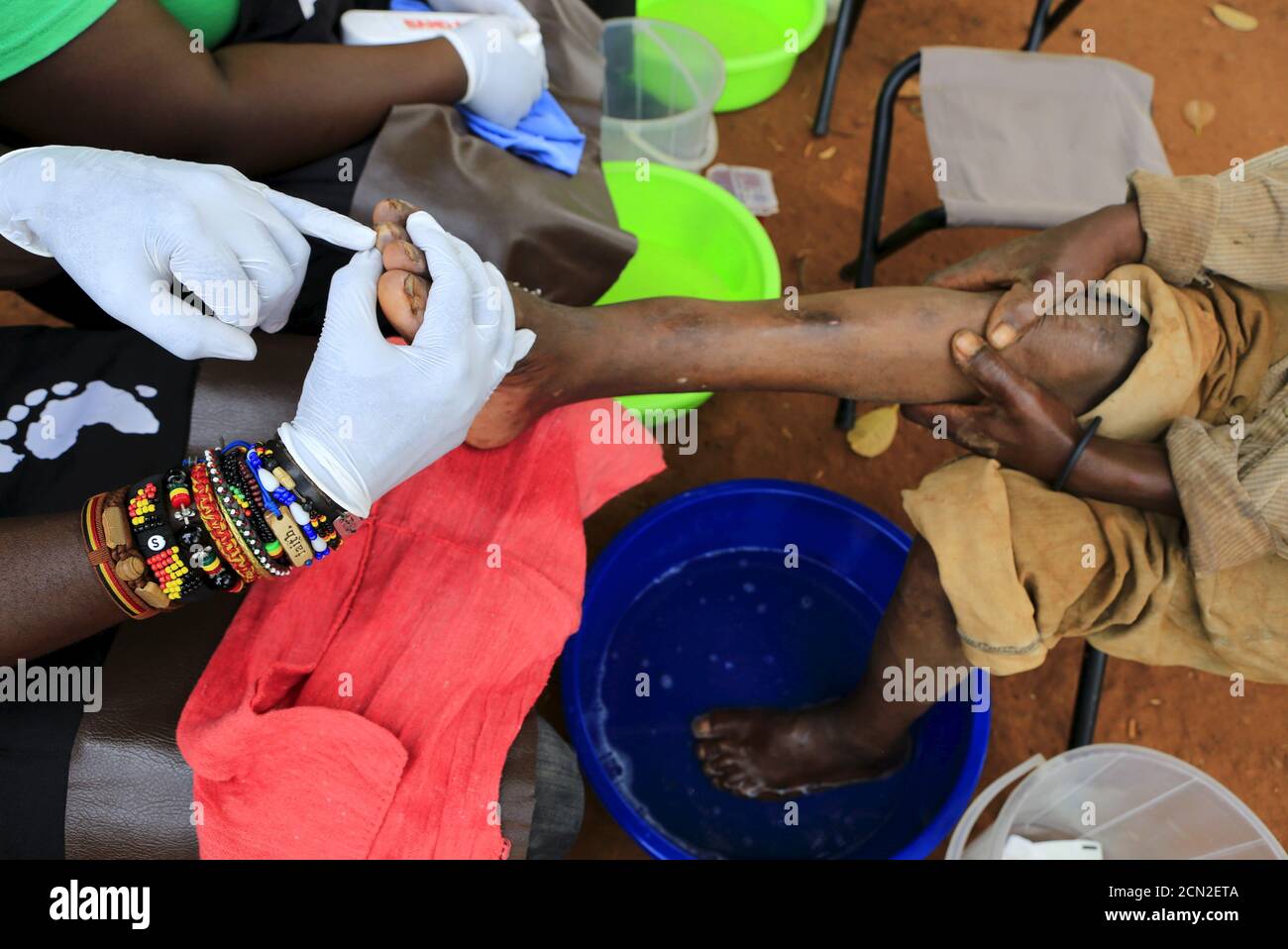 Un voluntario de Sole Hope examina el pie de un hombre infestado de