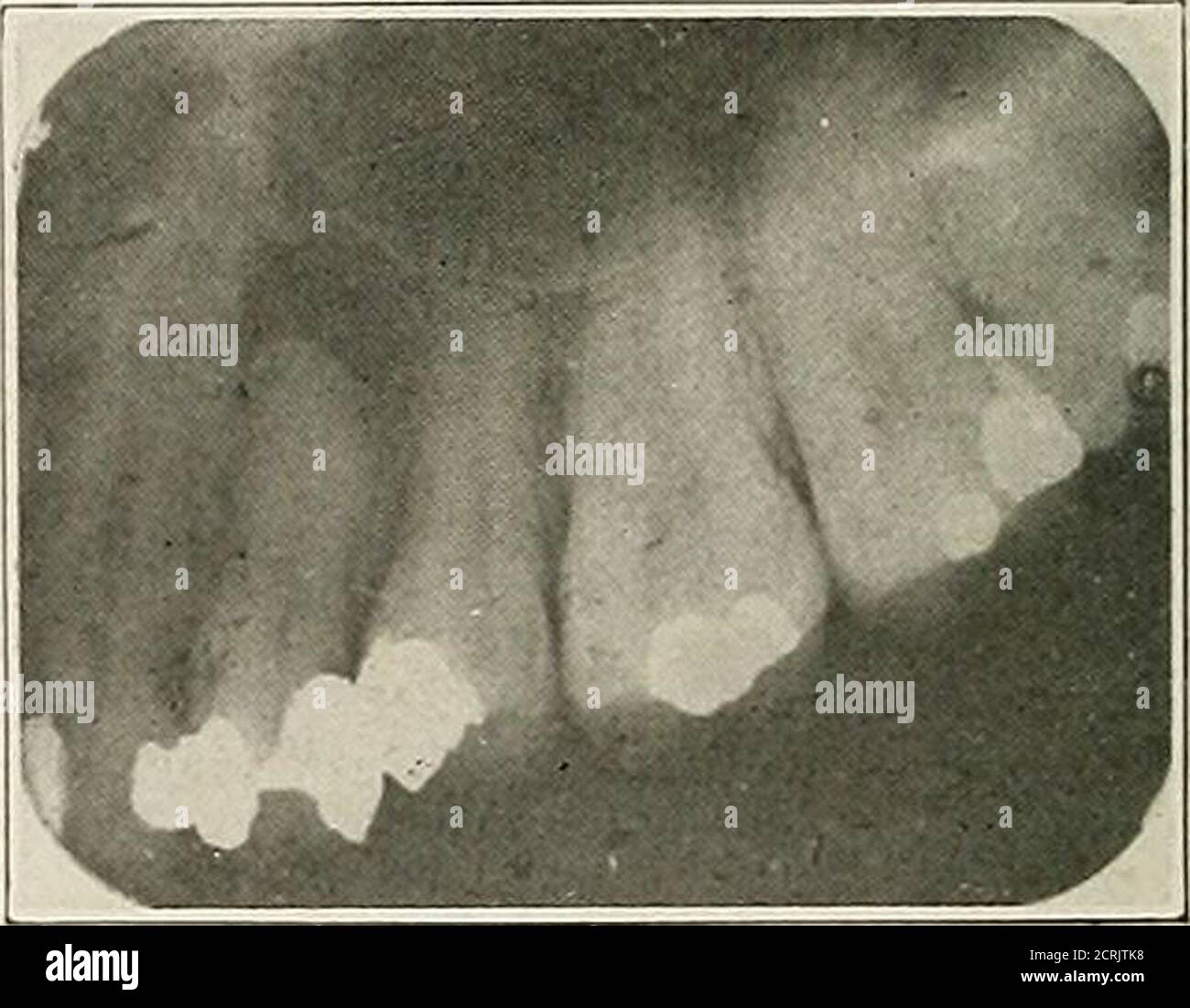 Interpretación de roentgenogramas dentales y maxilares . Fig. 114. Fig.  115. Fig. 114.—segundo canal de pulpa infectado premolar, sin evidencia de  relleno de raíz, área largeperiapical de osteotis crónica rarefying con