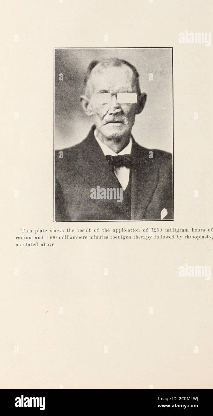 Pus Filled Fotos E Imagenes De Stock Alamy