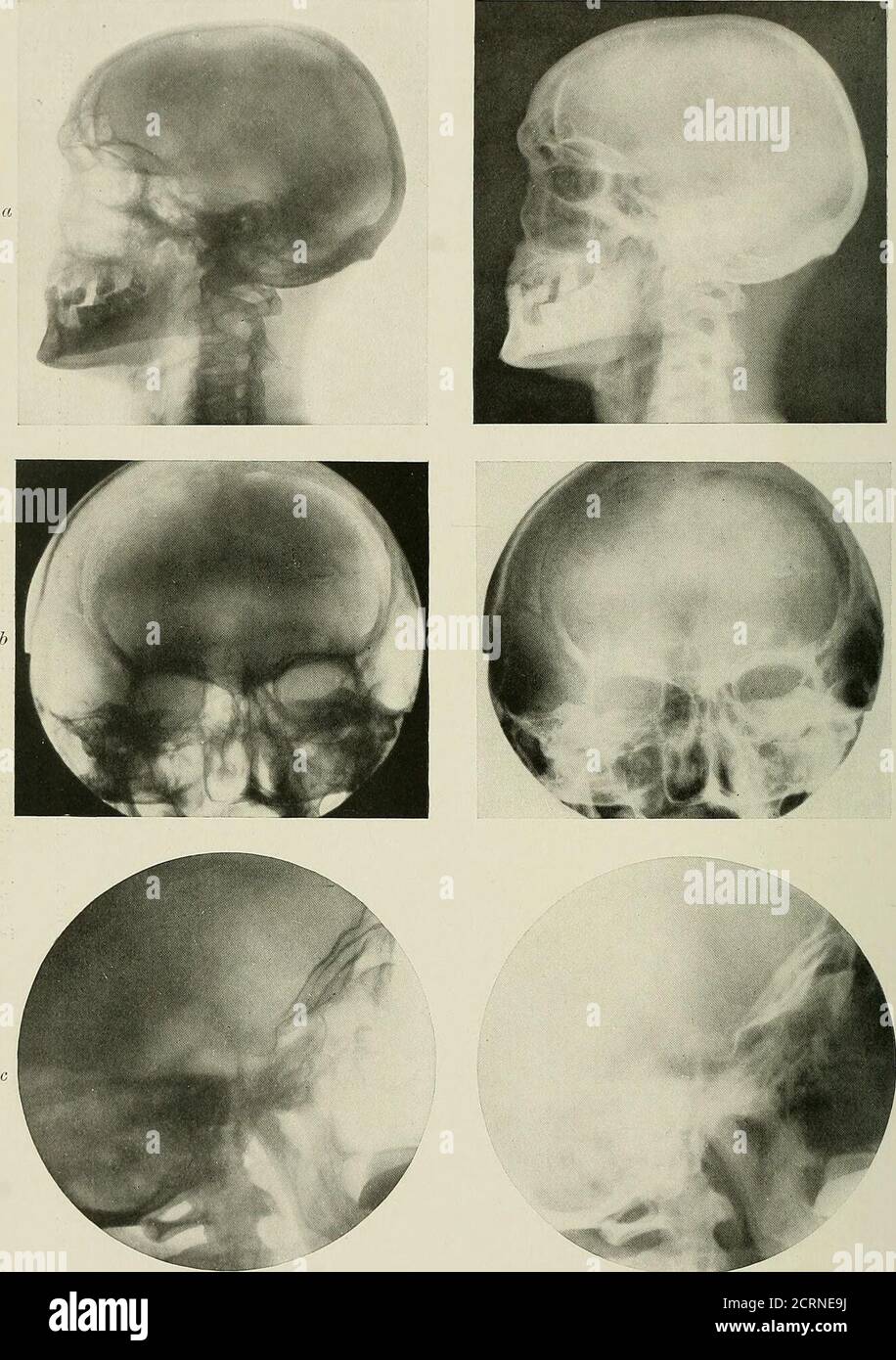 Radiografía y radioterapéutica . O ca a &lt;. PLACA XV—Skdlls normales. A,  Vista lateral del cráneo normal, mostrando senos frontales, senos  esfenoidales, silla turca, huesos temporales, vértebras cervicales, b,  Vista antero-posterior