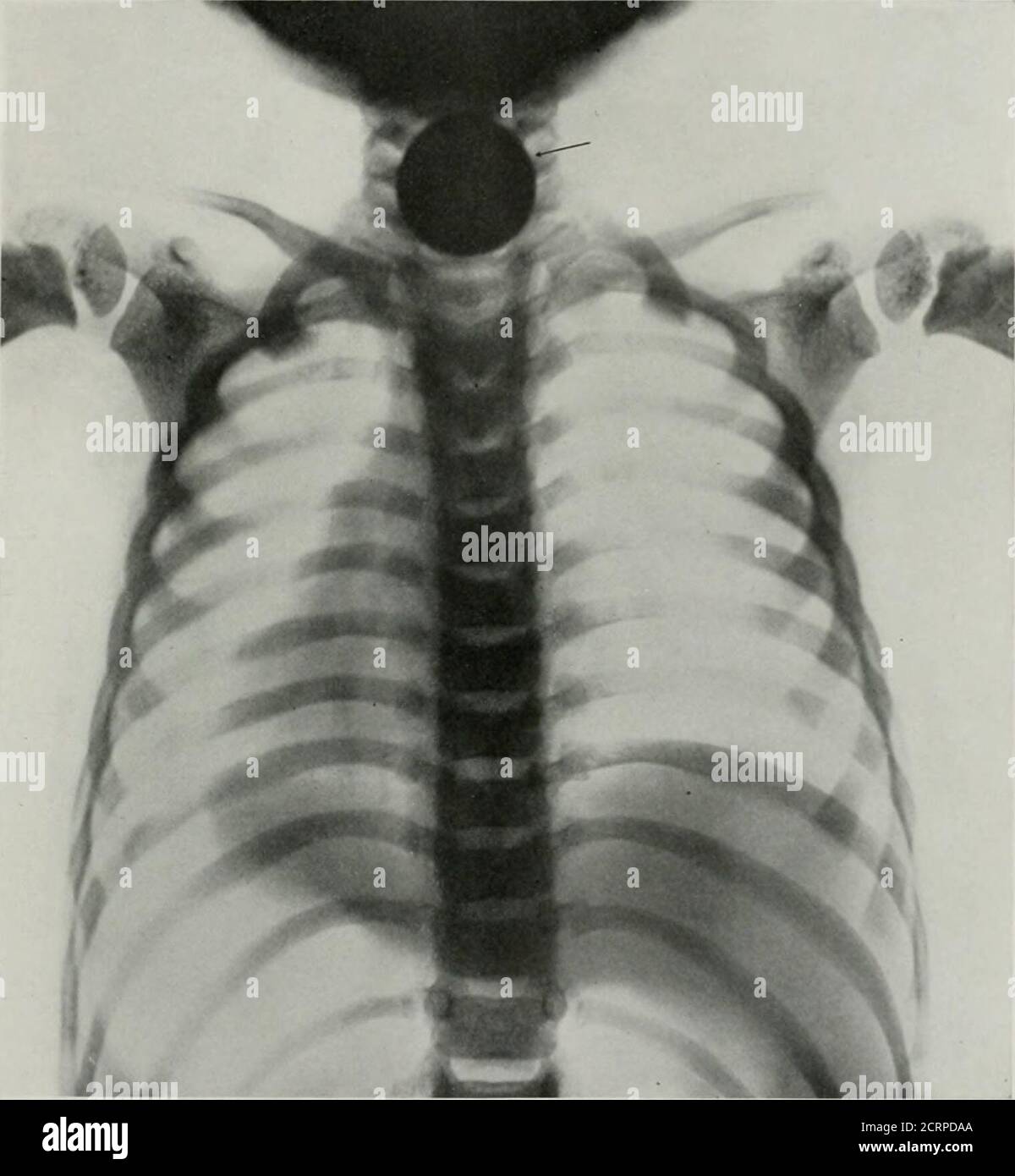 . Anatomía viva y patología; el diagnóstico de enfermedades en la vida temprana por el método de Roentgen . PI.ATK 145. CUERPO EXTRAÑO EN (ESÓFAGO. (Reducido en un 35%.) La flecha apunta hacia una ronda, Ivcn área de groat den-sity, causada por un viejo j uenny canadiense. Placa 145. PLATK LLFI.HOOK I. TIIIC I.AIJVXX. (HiUI. A e 4 jear.s.. (Tamaño real.) Placa 140 Foto de stock