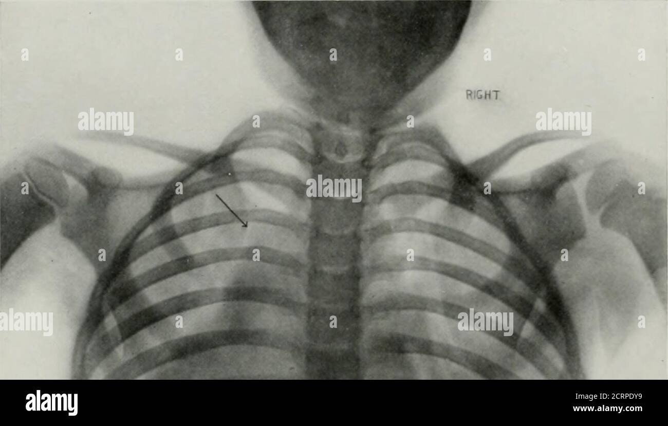 . Anatomía viva y patología; el diagnóstico de enfermedades en la vida temprana por el método de Roentgen . PI.ATI; I:5().ANEUHISM. Niño de 12 años. (Reducido en un 50%.) La flecha apunta hacia un área aumentada de densidad justo encima de la base del corazón, en el lado izquierdo del esternón, y presenta los signos clínicos de aneurisma. PI.ATE 1.3G. Foto de stock
