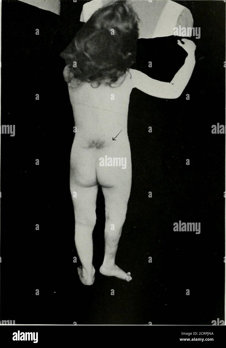 . Anatomía viva y patología; el diagnóstico de enfermedades en la vida temprana por el método de Roentgen . PI.ATK 42. SIIXA HIIIDA OCCN.TA. Niña, 3i año. (El mismo tema que las placas 43 y 44.) La flecha apunta al pelo y a los que cubren el defecto en la vértebra-. Di.slocatiou cong�ito de risiht cadera. Platk 42. PLAT1-. 43. PPIXA BIFIDA OCTTLTA. Niña de 3 años. (El mismo tema que las placas 42 y 44.) A. la tercera vértebra lumbar estrecha. B. el tercer disco intcivertebral estrecho. C. sacralización de la quinta vértebra lumbar izquierda. D. solo al risiht y debajo del punto de la flecha i.-; fissu Foto de stock