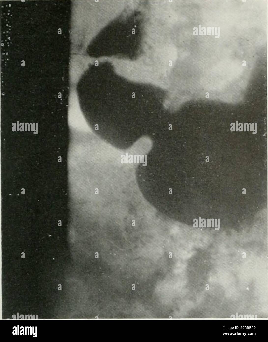 . La revista americana de roentgoenología, terapia de radio y medicina nuclear. Fig. i y Ilustra un velo tailandés ii < superficie exterior ol el i ap, thi gall i Lad lei y h< ■ re del colon lleno de g Fig. i el 4. Demontrant une voile qui comprend la surface ieureladu b ale, vesicule biliaire et la flexion tique du colon emplie pai l<Fig. j et V- Ilustrando un velo que envuelve la caxa externa delbulbo y duodenal, la vesfcula biliai y al Utica del colon. Velos en el hipocondrio derecho 43. Foto de stock