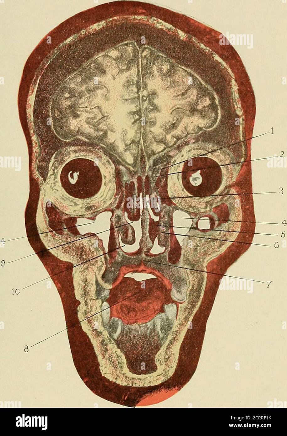 Enfermedades de la nariz y la garganta . Fig. 65.—masa caseosa lavada de  antro a través del maxillare del throughostium. Veces los vasos sanguíneos  se rompen en diferentes lugares, causando poco