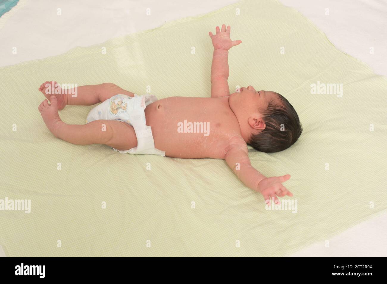 Niño recién nacido de 1 semanas en pañal en la espalda reflejo de sobresalto Reflex de Moro pelando la piel escamosa típico del recién nacido Foto de stock
