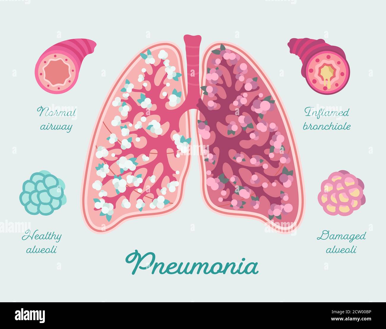 Neumonía en los pulmones humanos. Inflamación de los pulmones incluso