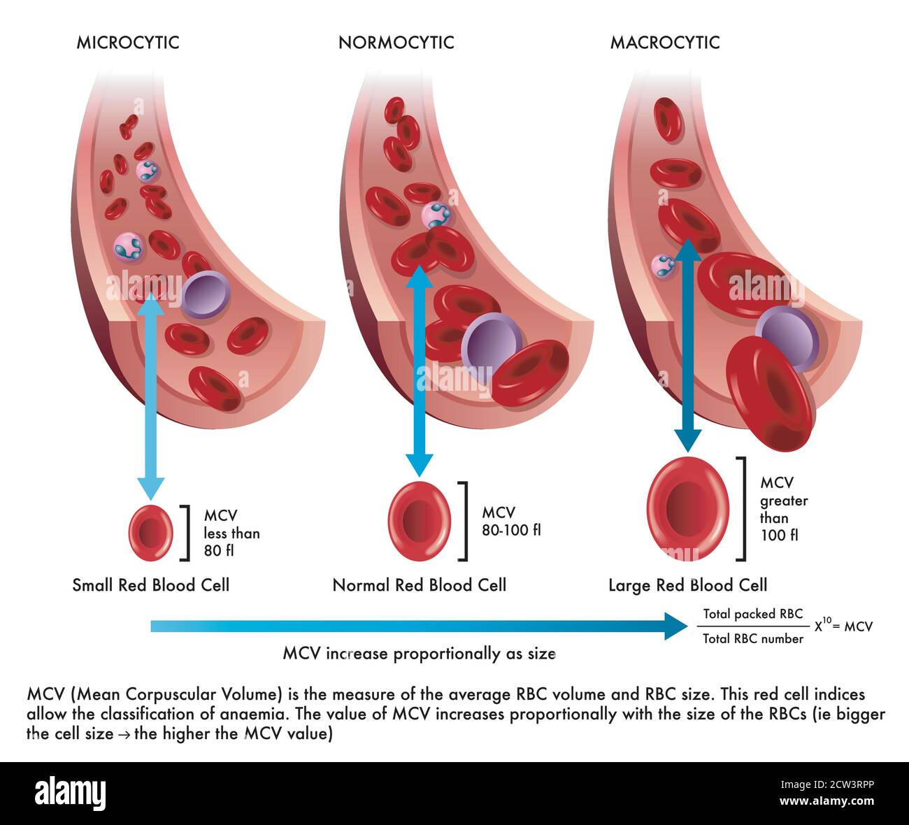 la ilustración muestra la diferencia entre una célula sanguínea roja normal con una afectada por la microcitosis y otra por la macrocitosis, con anotaciones Ilustración del Vector
