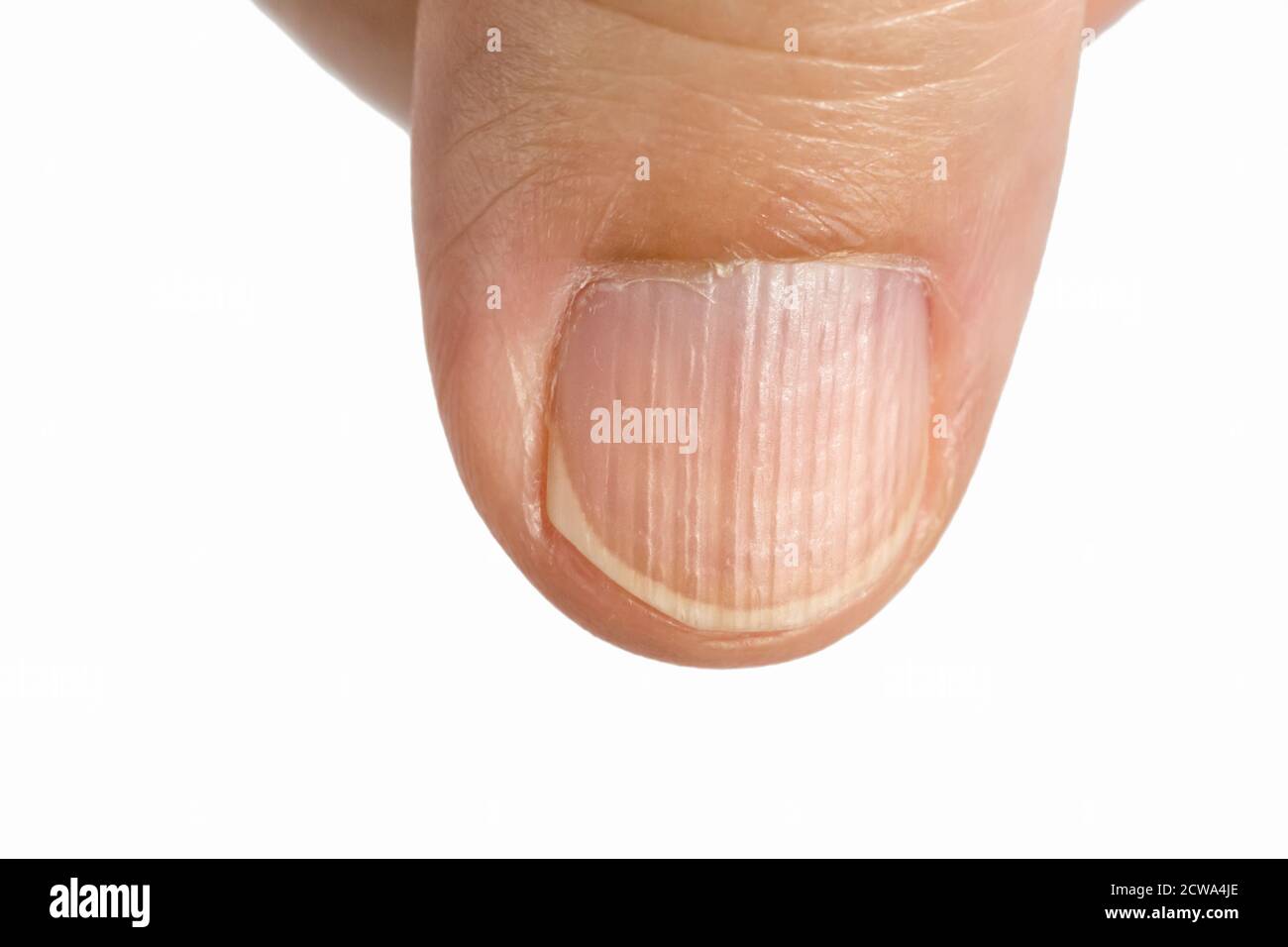 Las crestas verticales en las uñas síntomas de deficiencia de vitaminas y  minerales Fotografía de stock - Alamy