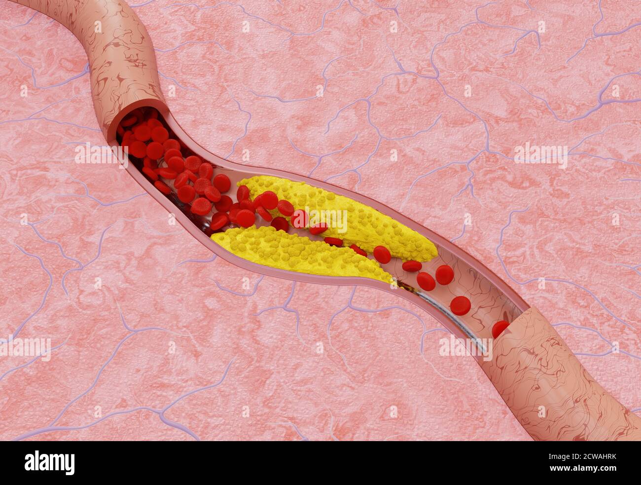 Aterosclerosis en la arteria. Concepto médico. Ilustración 3D Foto de stock