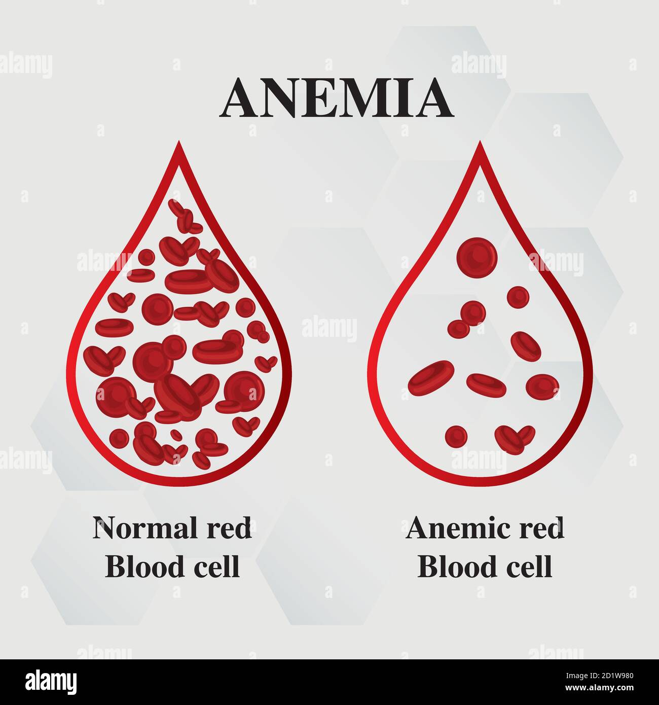 Anemia cantidad de sangre roja deficiencia de hierro Anemia diferencia de  anemia cantidad de glóbulos rojos y síntomas normales vector ilustración  médica Imagen Vector de stock - Alamy