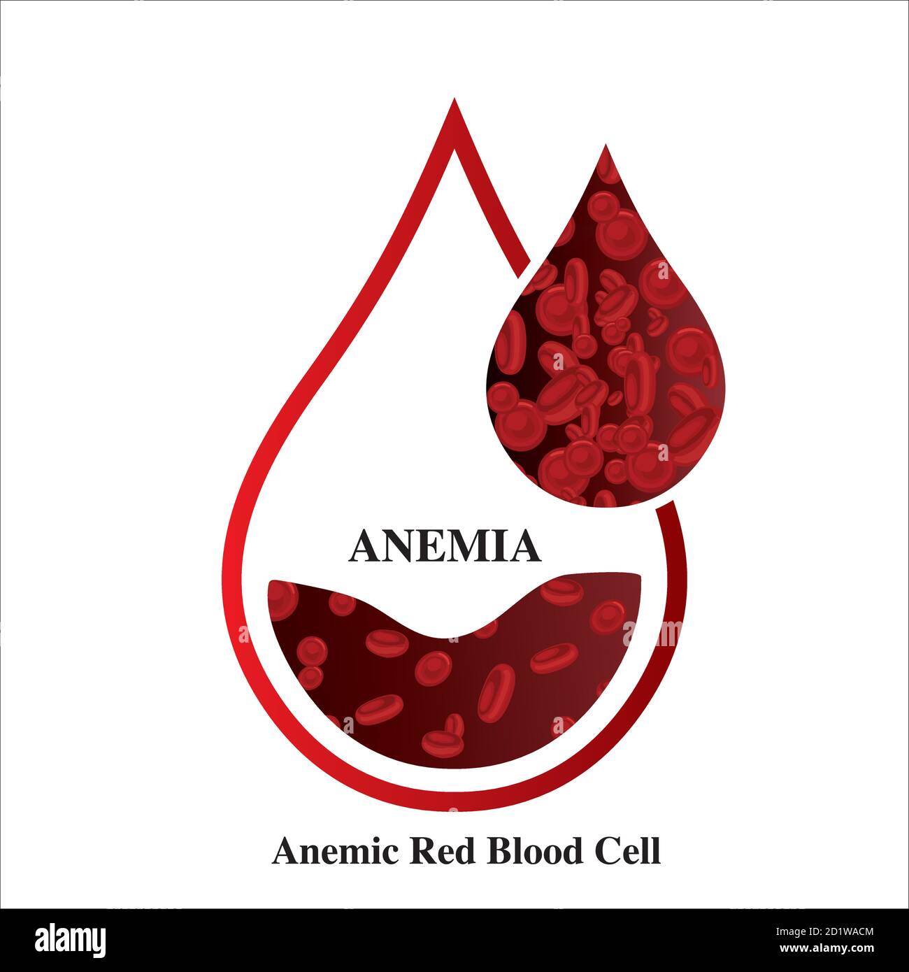La anemia por deficiencia de hierro Imágenes vectoriales de stock - Alamy