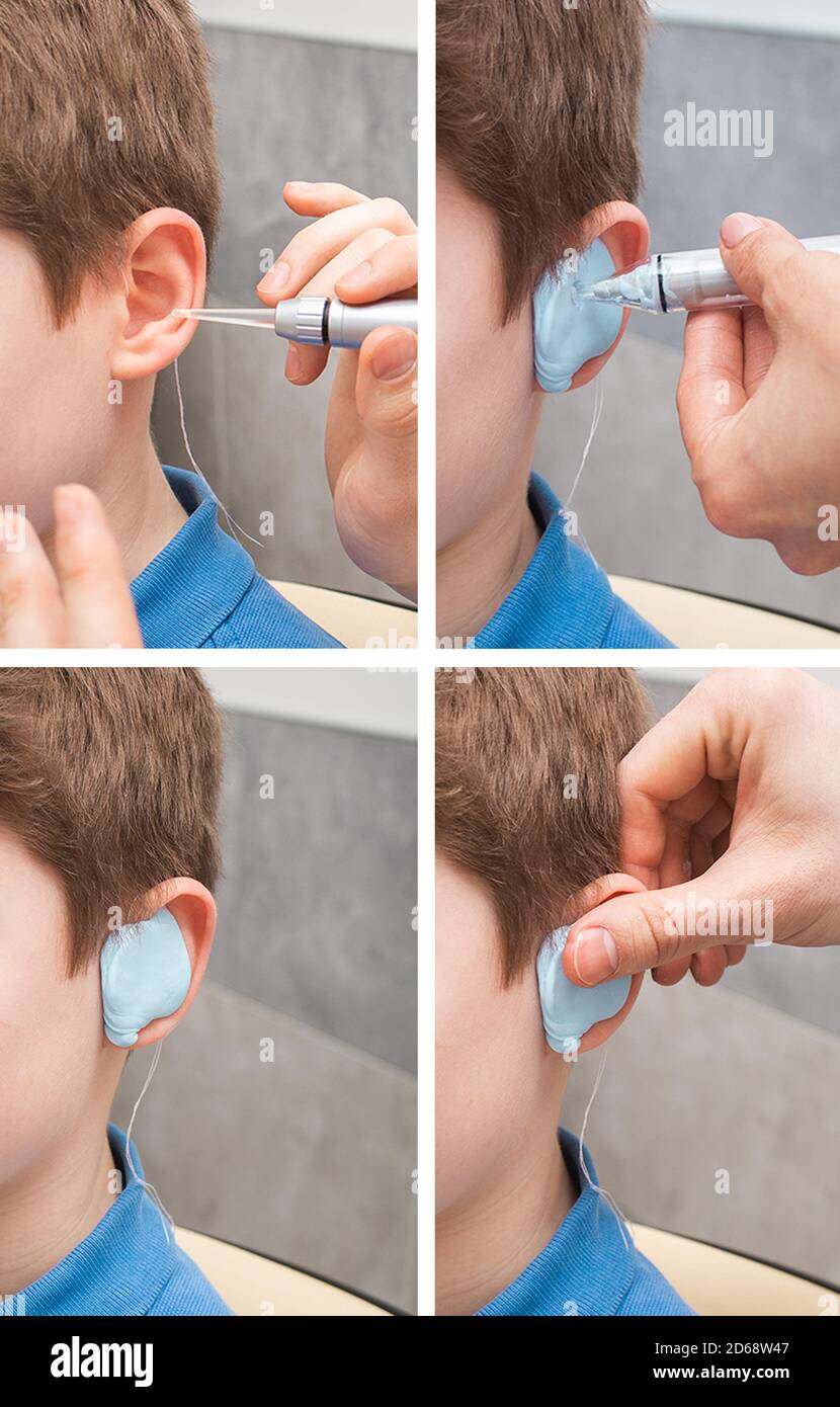 Juego de hacer un tapón para los oídos personalizado para un niño. Etapas  de fabricación de tapones para los oídos. El médico fabrica tapones para  los oídos moldeados a medida para el