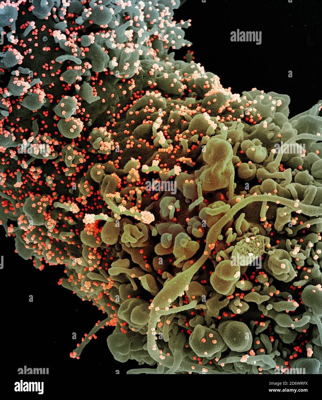 Micrografía electrónica de barrido coloreada de una célula que muestra signos morfológicos de apoptosis, infectada con partículas del virus SARS-COV-2 (naranja), aislada Foto de stock