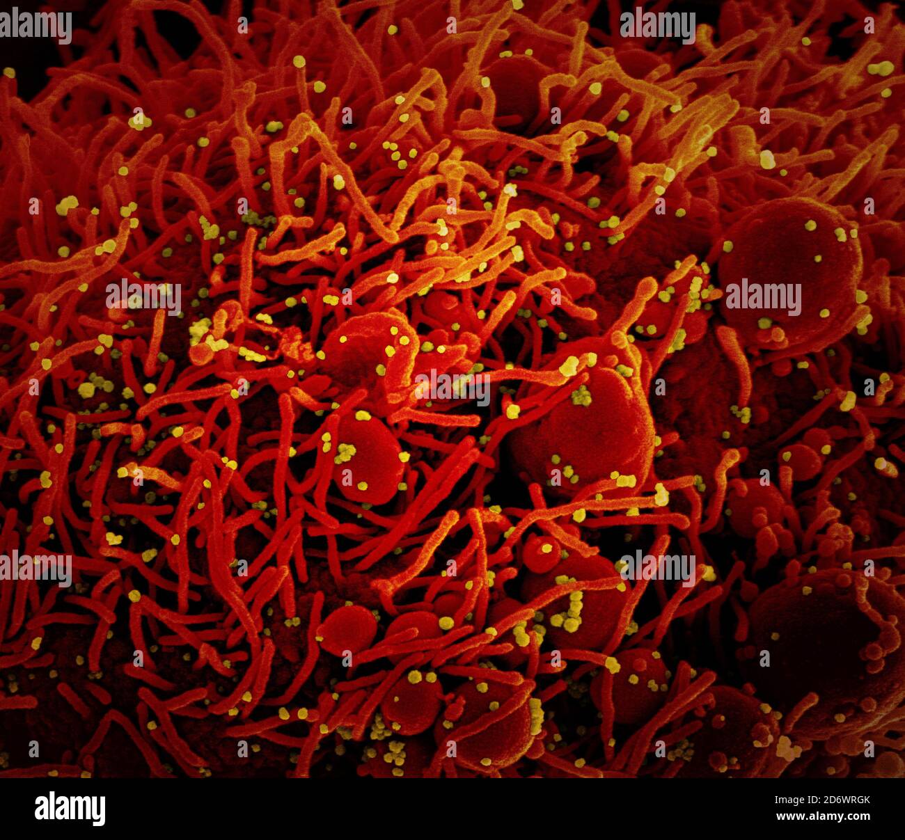 Micrografía electrónica de exploración coloreada de una célula apoptótica (roja) infectada con partículas del virus SARS-COV-2 (amarilla), aislada de una muestra de paciente. YO Foto de stock