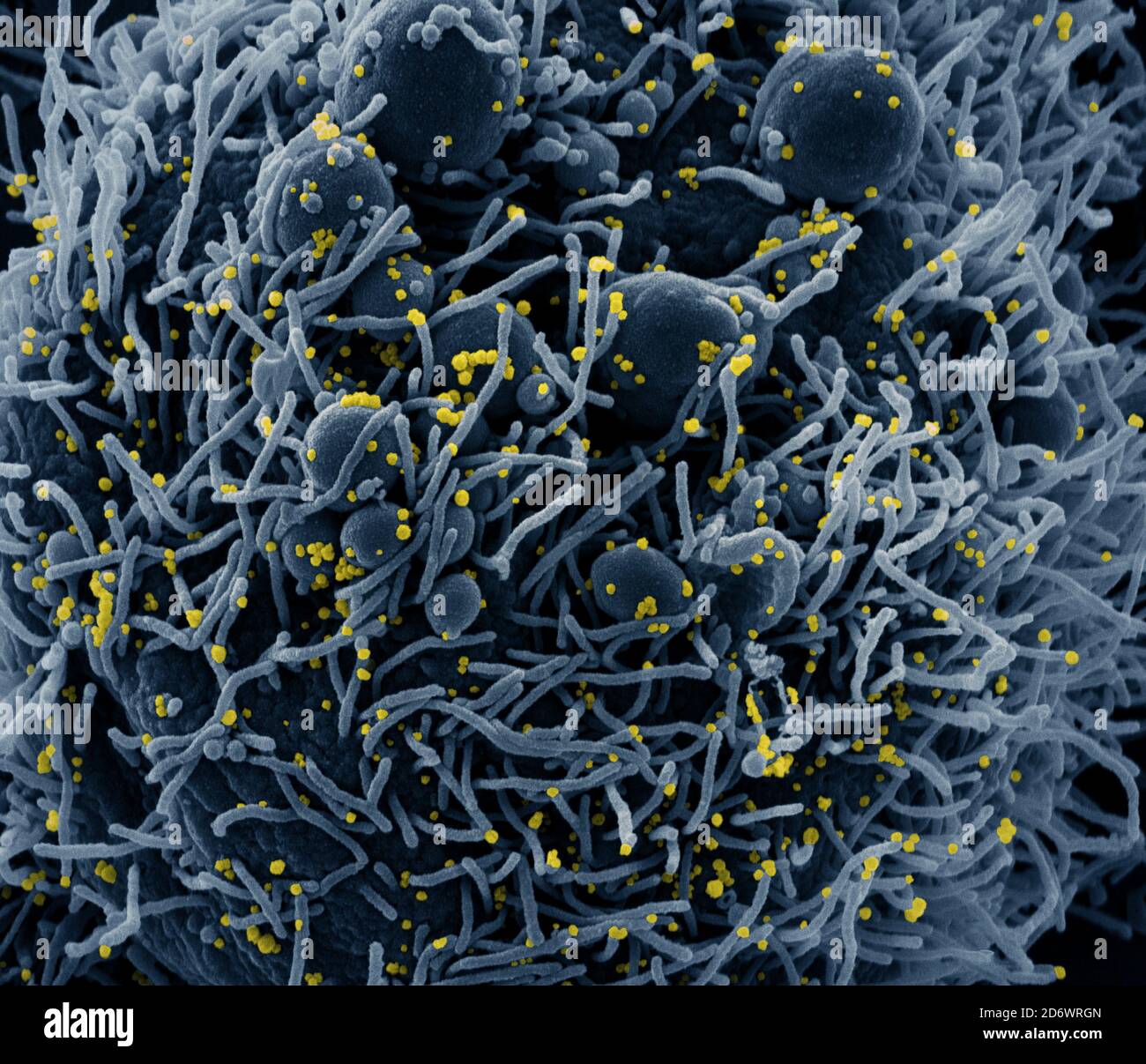 Micrografía electrónica de exploración coloreada de una célula apoptótica (azul) infectada con partículas del virus SARS-COV-2 (amarillo), aislada de una muestra de paciente. Foto de stock