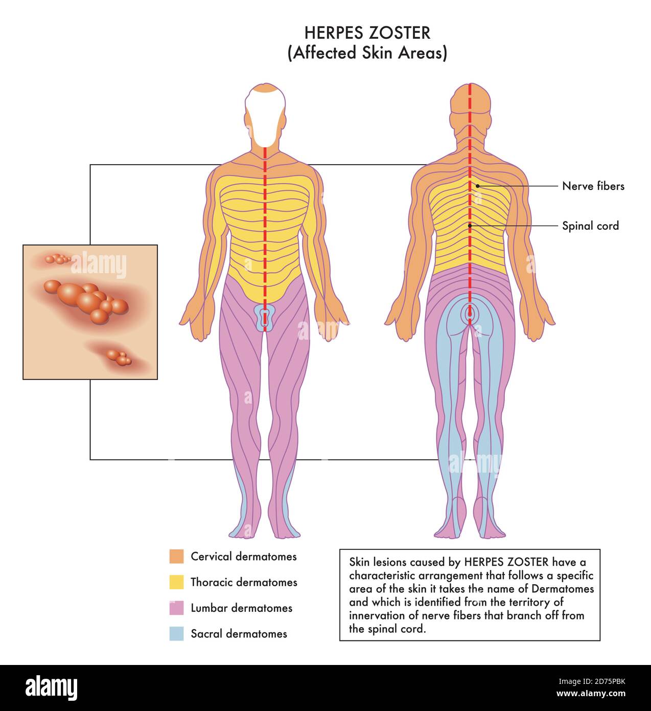 Diagrama médico de áreas de piel afectadas de Herpes Zoster con anotaciones. Ilustración del Vector