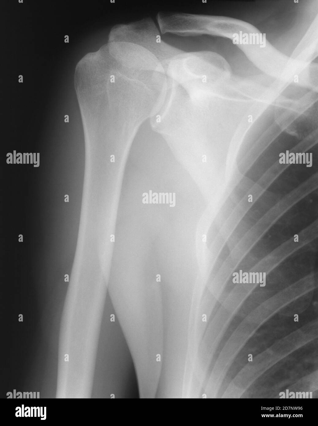Imagen de rayos X del hombro derecho. Foto de stock