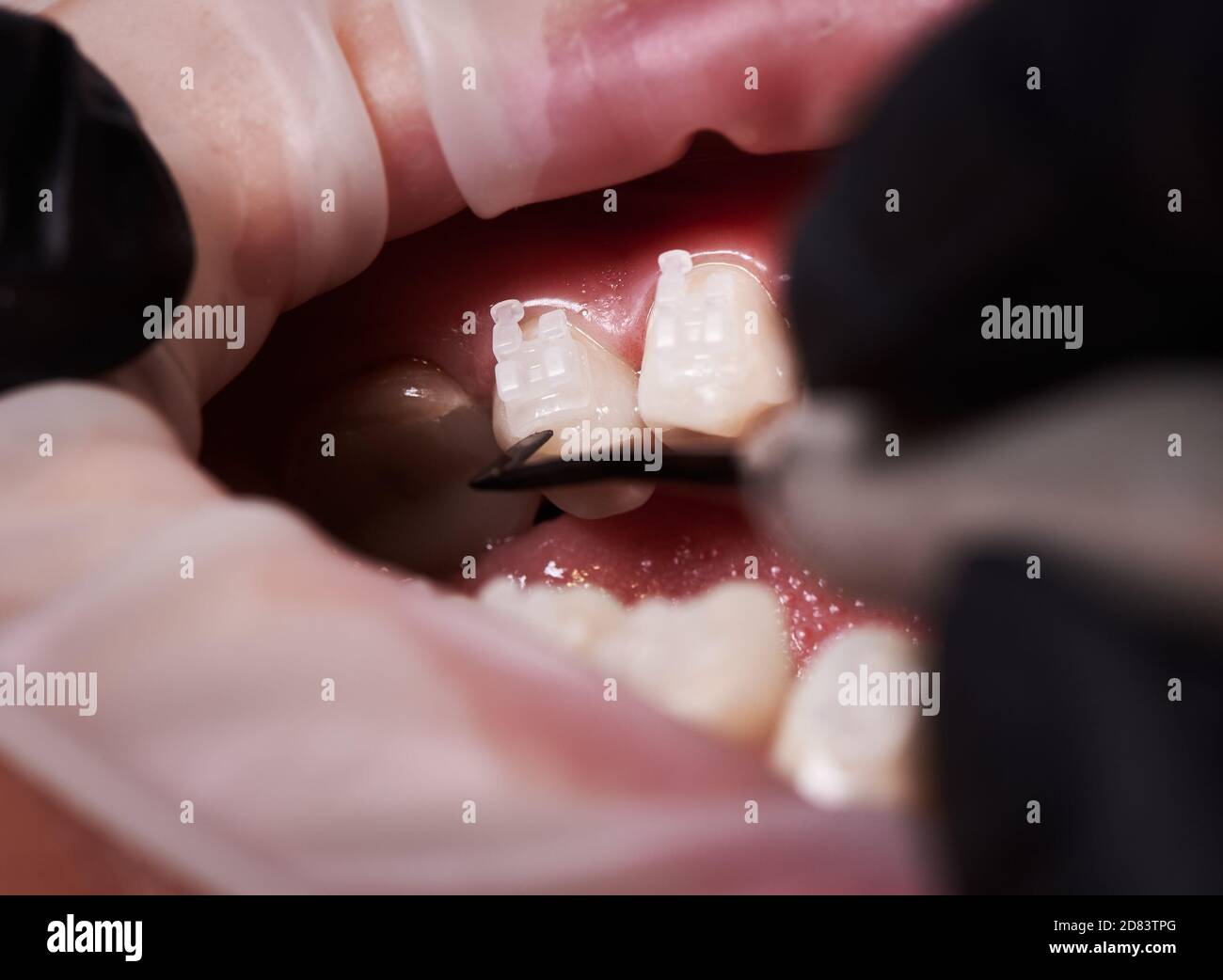 Primer plano de ortodoncista poniendo soportes de ortodoncia en los dientes del paciente. Persona con retractor de mejilla en la boca y aparatos ortopédicos en los dientes que tienen procedimiento dental. Concepto de estomatología, tratamiento ortodóntico. Foto de stock