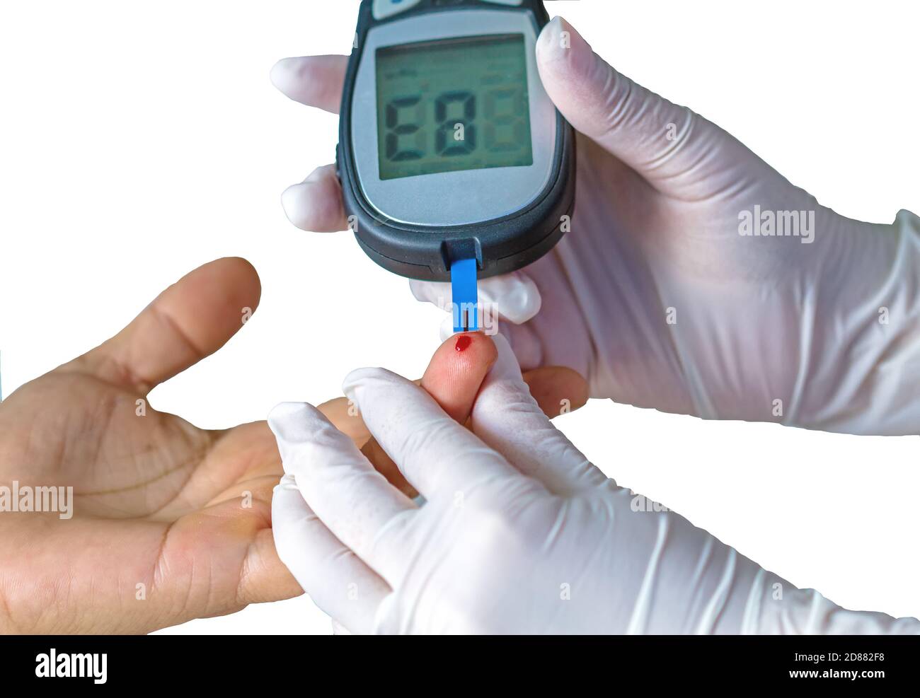medidor de glucosa en sangre, el valor de azúcar en sangre se mide en un  dedo,mostrar puntuación 862 mg es hiperglucemia Fotografía de stock - Alamy