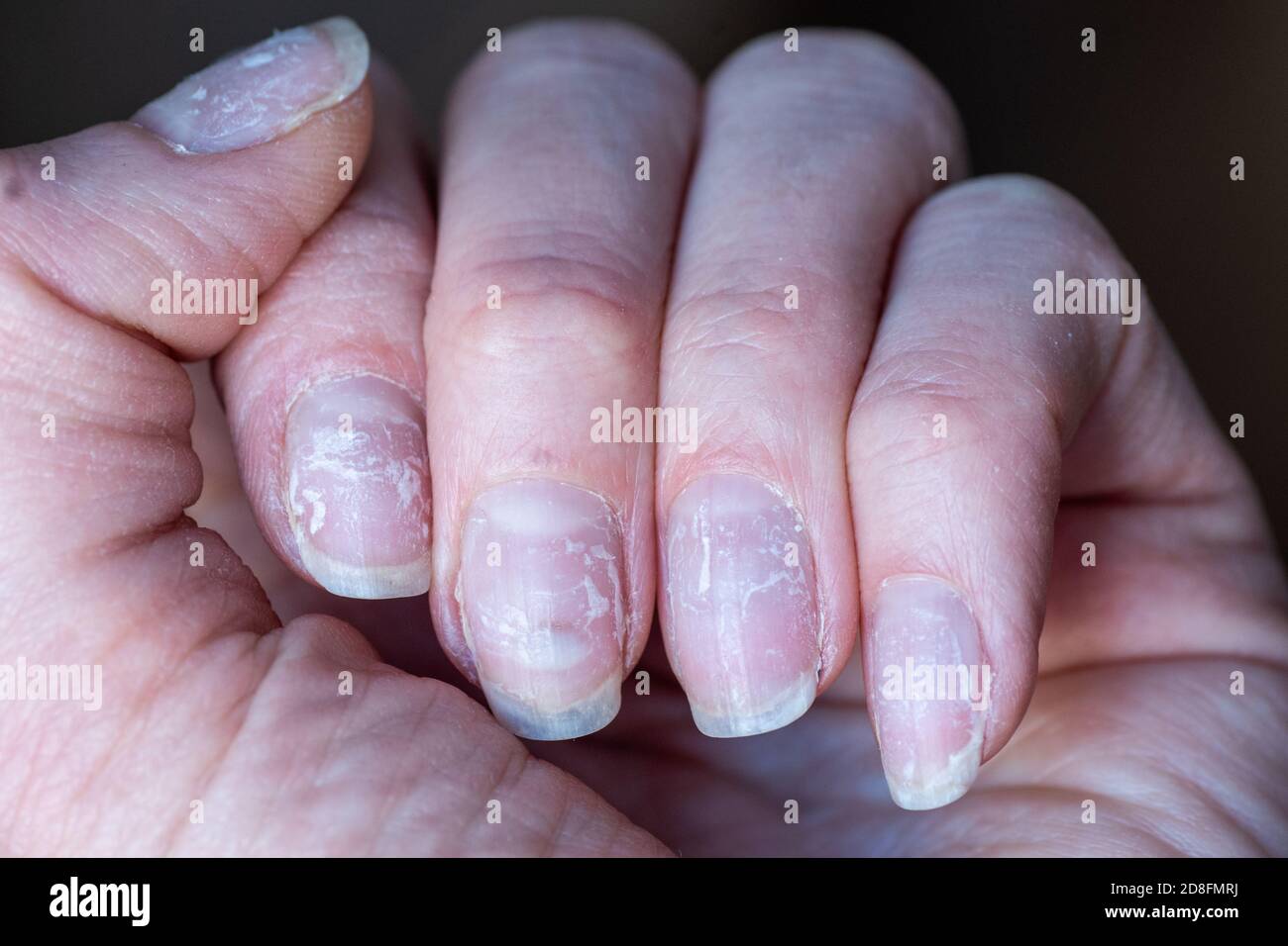 Primer plano de uñas quebradizas. Daños en la uña después de usar laca o gel  pulido. Pelado en las uñas daño a la uña Fotografía de stock - Alamy