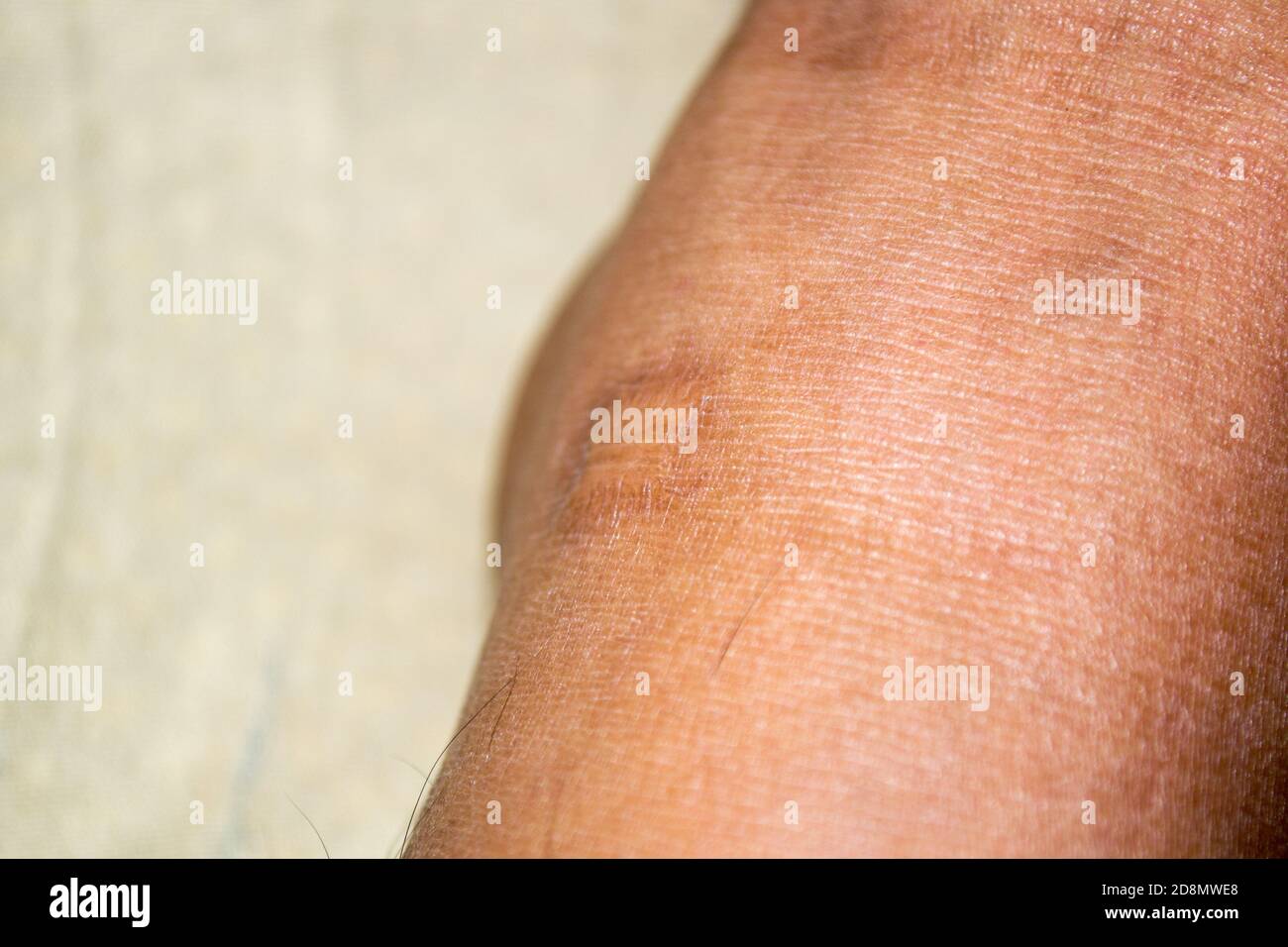 Queloide De Forma Cuadrada Fotos e Imágenes de stock - Alamy