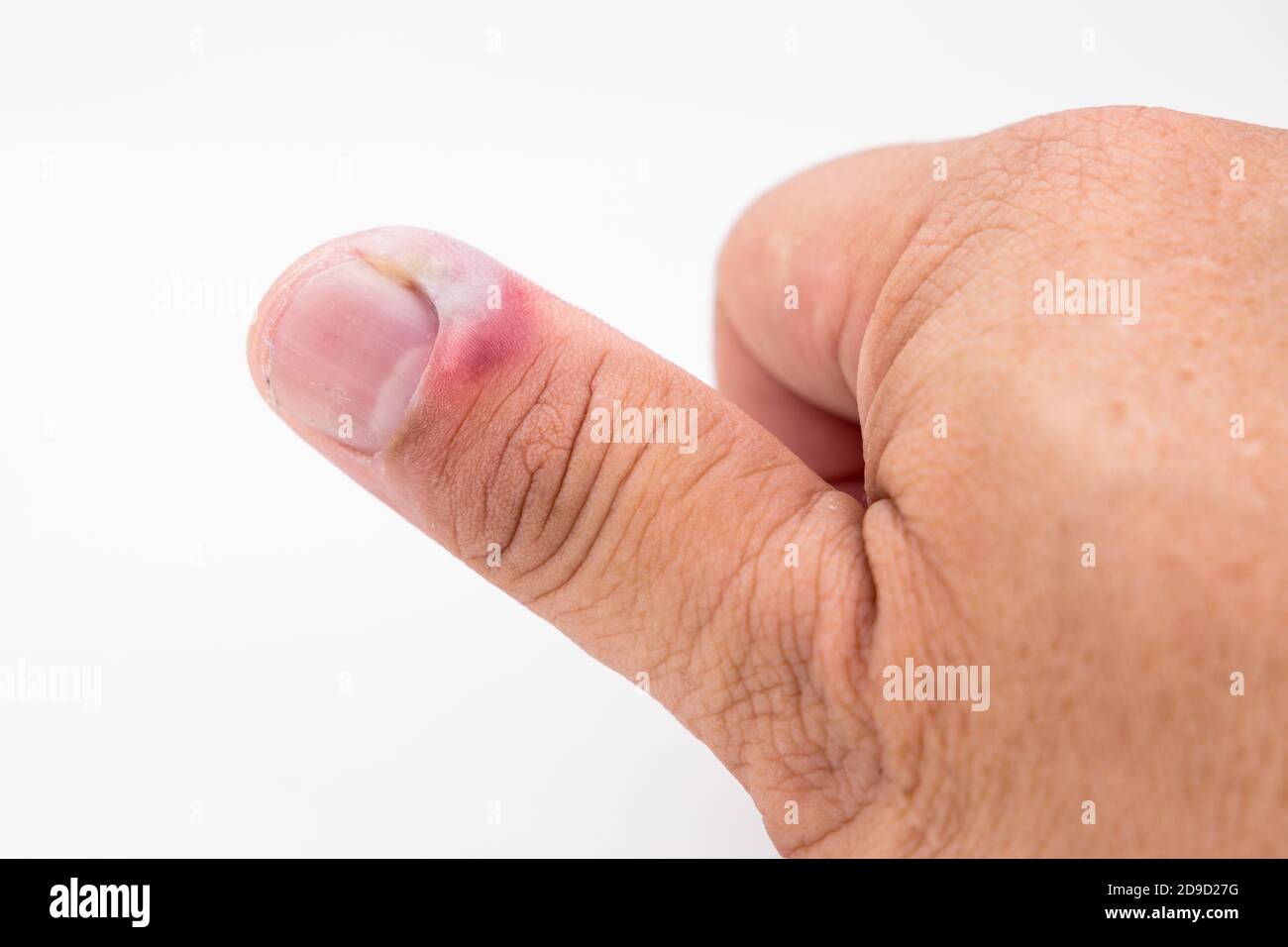 Serie de infección dolorosa de la piel de la uña del dedo con tratamiento del pus Foto de stock