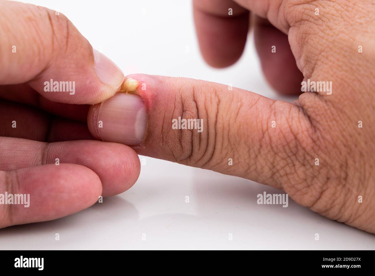 Infección del dedo fotografías e imágenes de alta resolución - Alamy