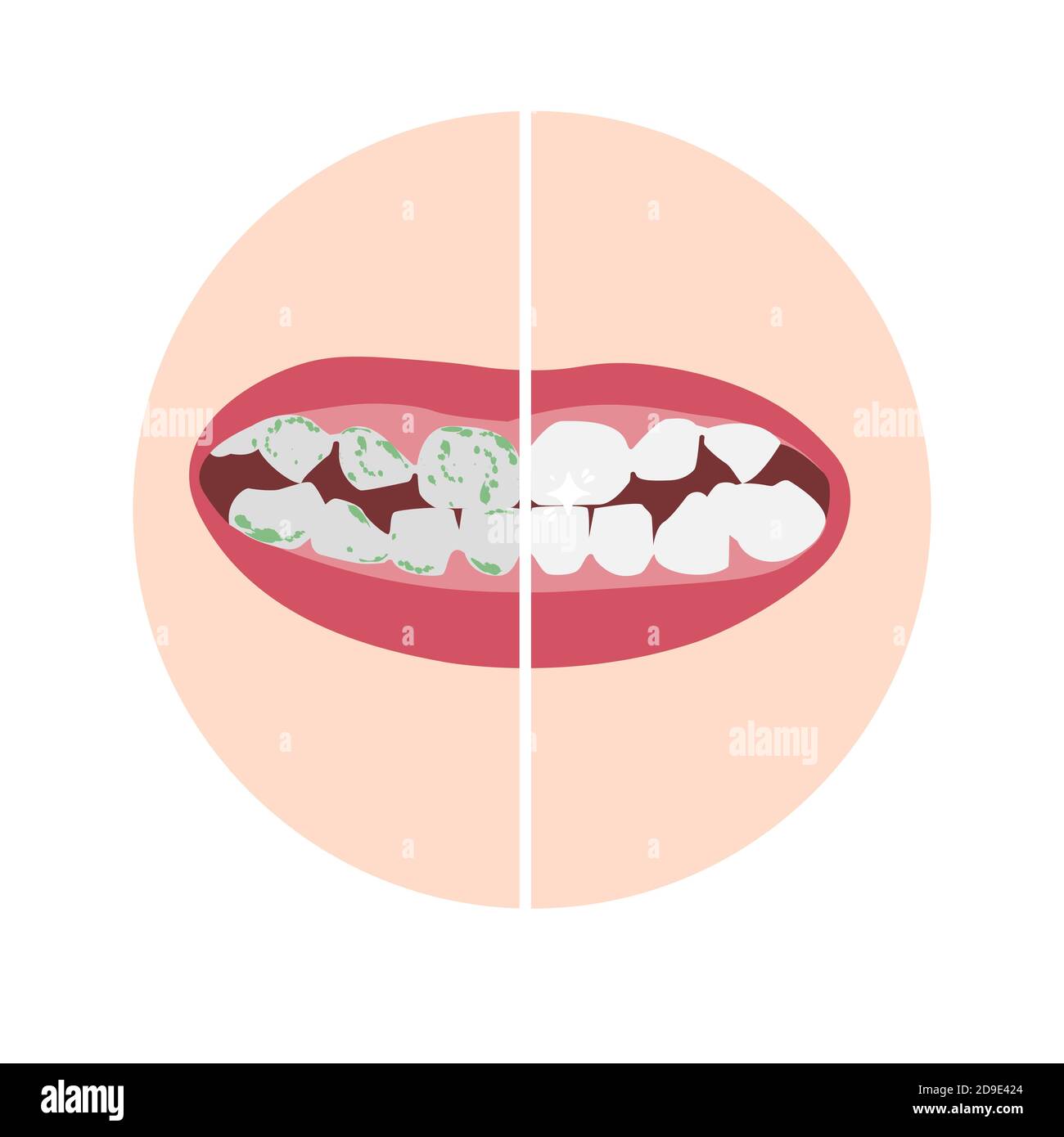 Dientes y dientes blancos sanos con placa verde, bacterias, virus. Ilustración del Vector