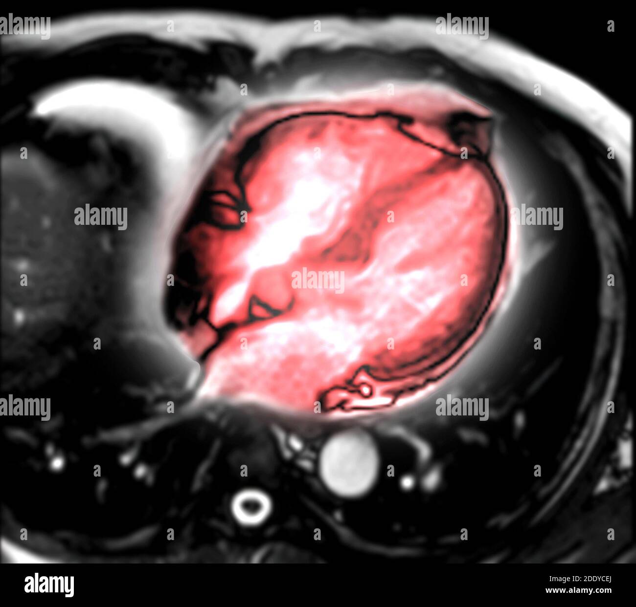 IRM del corazón o del corazón IRM ( imágenes por resonancia magnética ) de la vista del eje vertical del corazón que muestra 4 cámaras del corazón para el diagnóstico de enfermedad cardíaca. Foto de stock