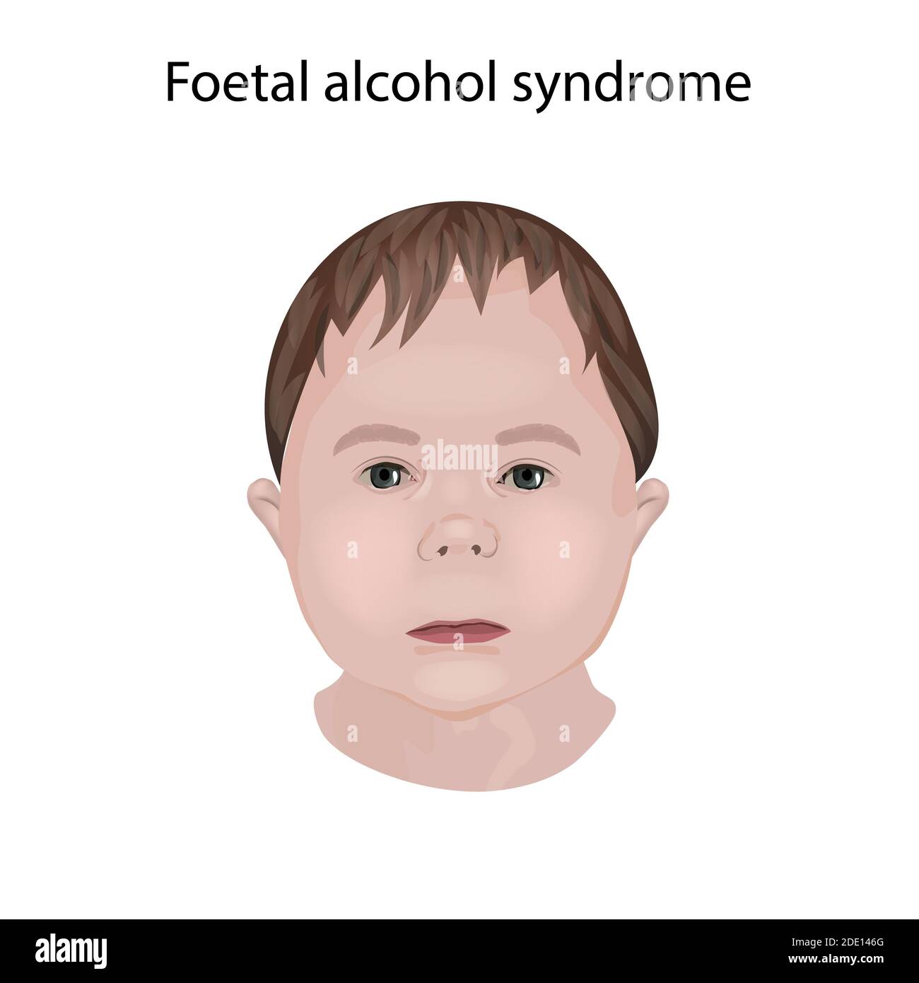 Síndrome Del Alcohol Fetal Ilustración Fotografía De Stock Alamy 