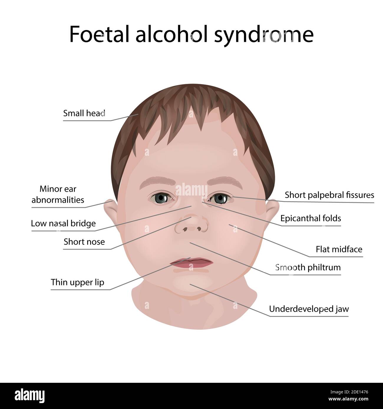 Sindrome Del Alcoholismo Fetal Monografias The Best Porn Website