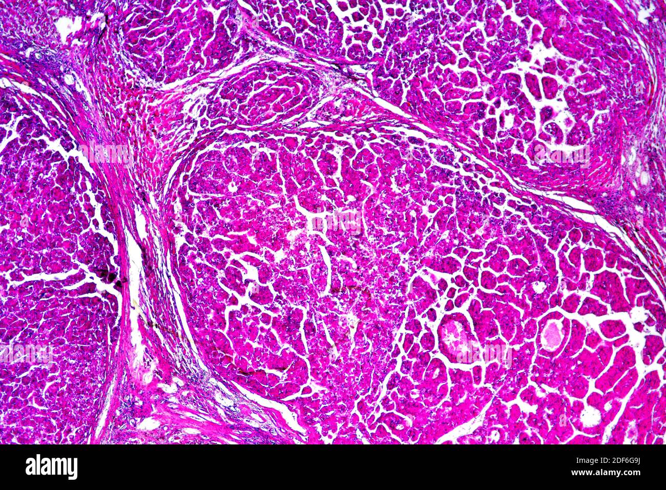 Hígado humano con carcinoma metastásico. Microscopio óptico X40. Foto de stock