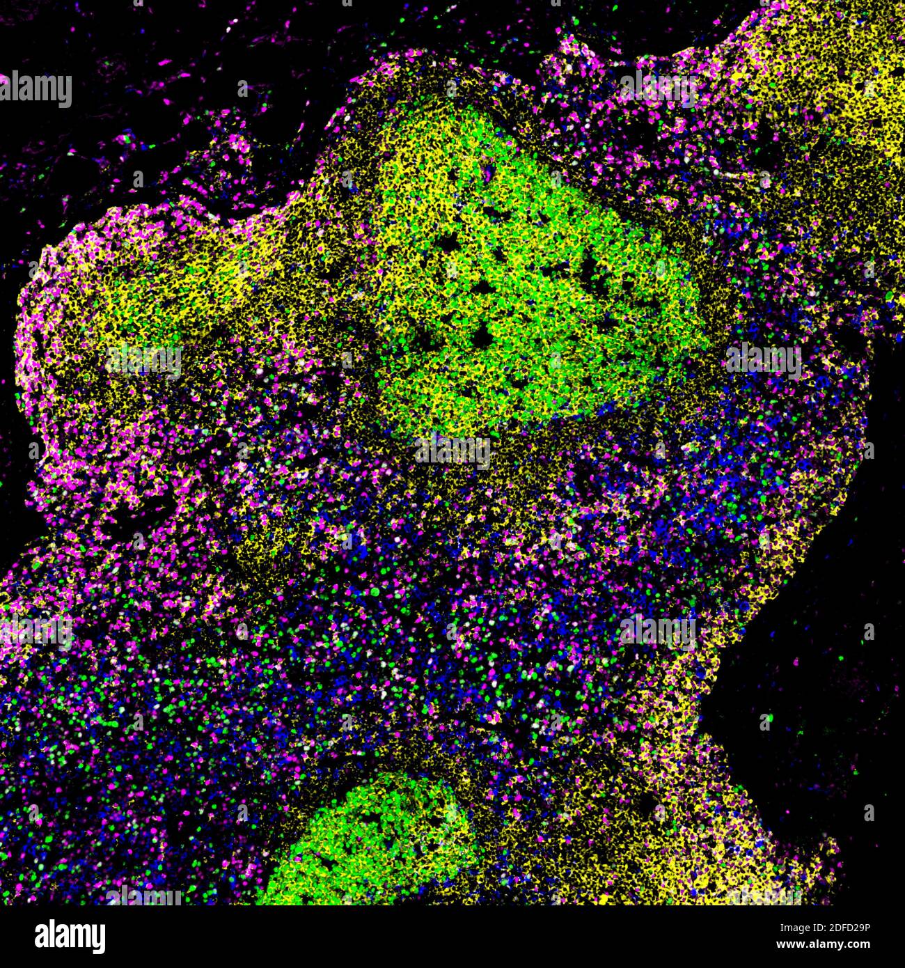 Imagen microscópica de un ganglio linfático biopsiado de una persona con VIH no tratado, que muestra grandes centros germinales que contienen células B proliferantes anormales Foto de stock