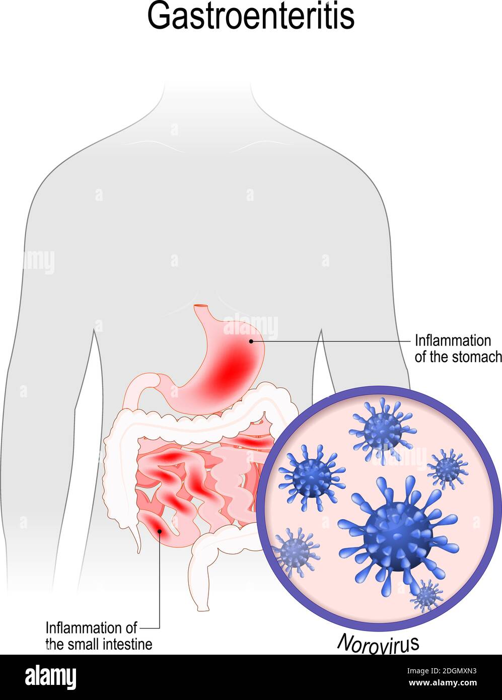 gastroenteritis. Enfermedad viral causada por norovirus. Silueta humana con inflamación del intestino delgado y el estómago Ilustración del Vector