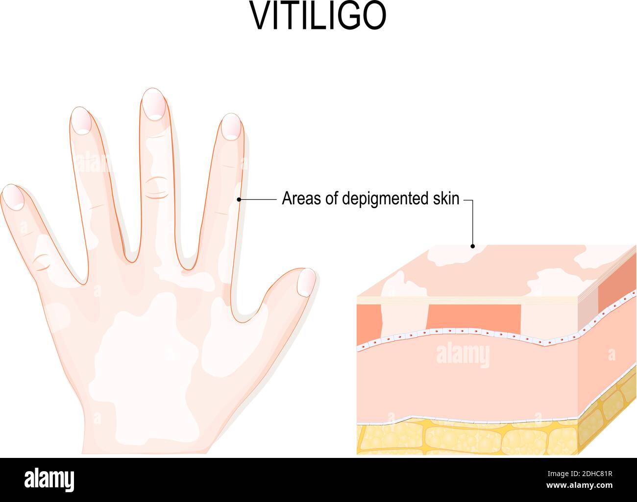 Vitiligo. Es una condición de la piel caracterizada por porciones de la piel que pierden su pigmento. Ocurre cuando las células pigmentadas de la piel (melanocitos) Ilustración del Vector
