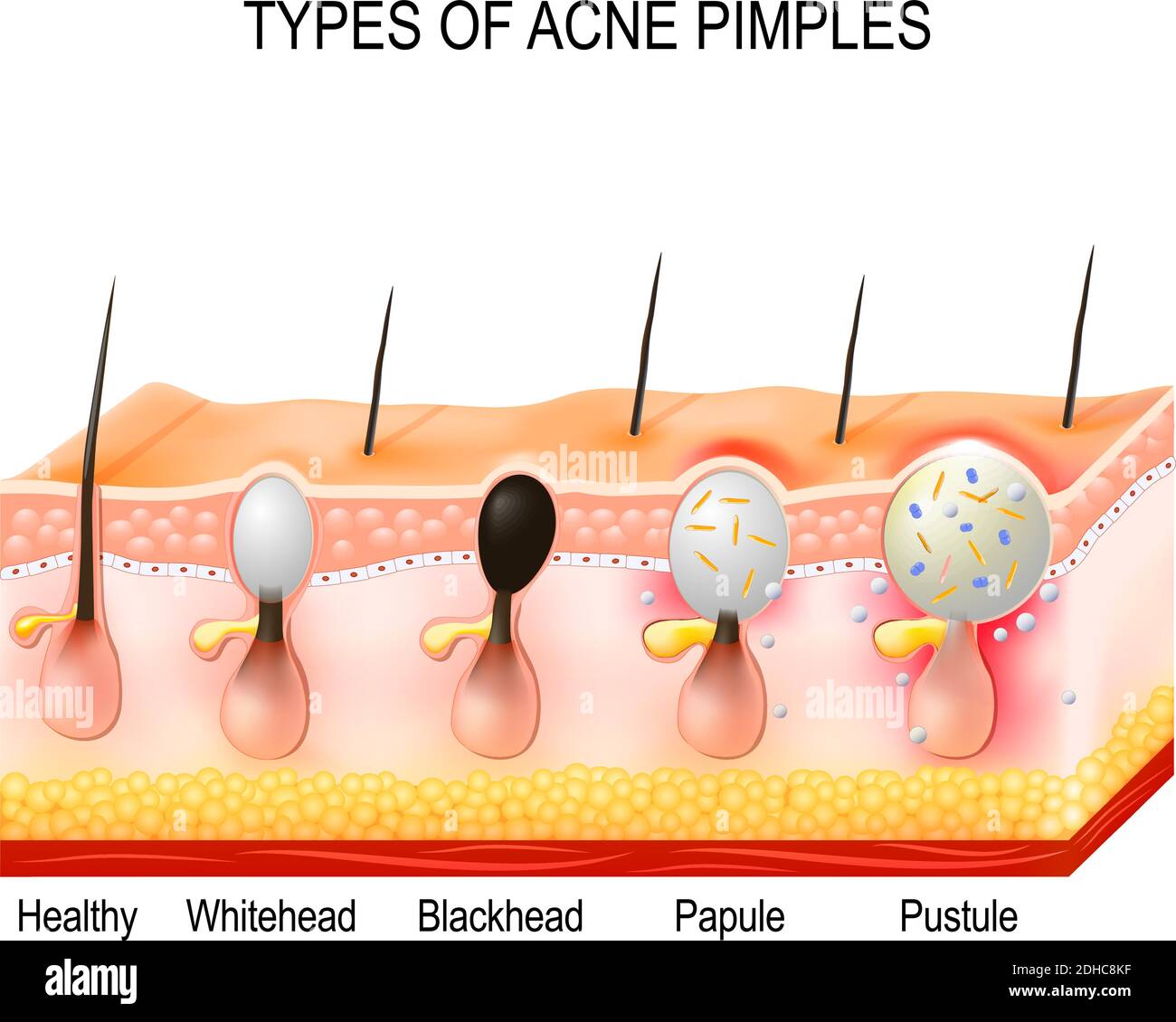Tipos de granos de acné. Piel sana, Whiteheads y Blackheads, pápulas y  pústulas Imagen Vector de stock - Alamy