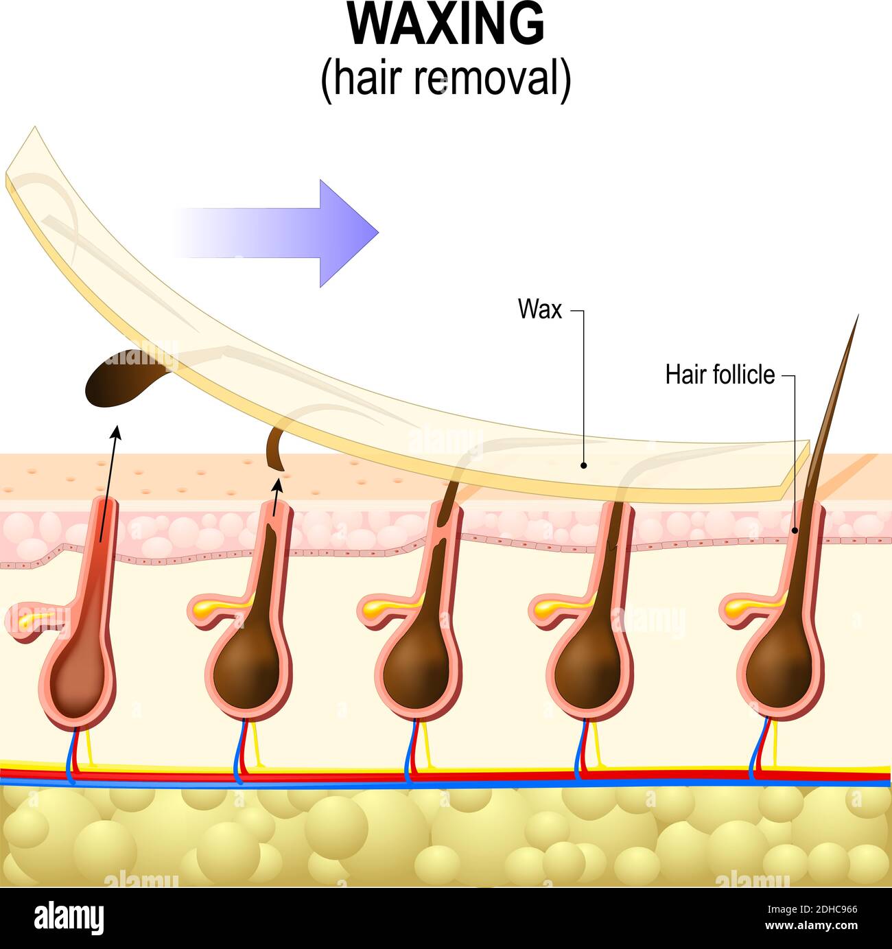 Eliminación del vello. El encerado es una forma de eliminación del cabello semi-permanente que elimina el cabello. Estructura de la piel humana Ilustración del Vector