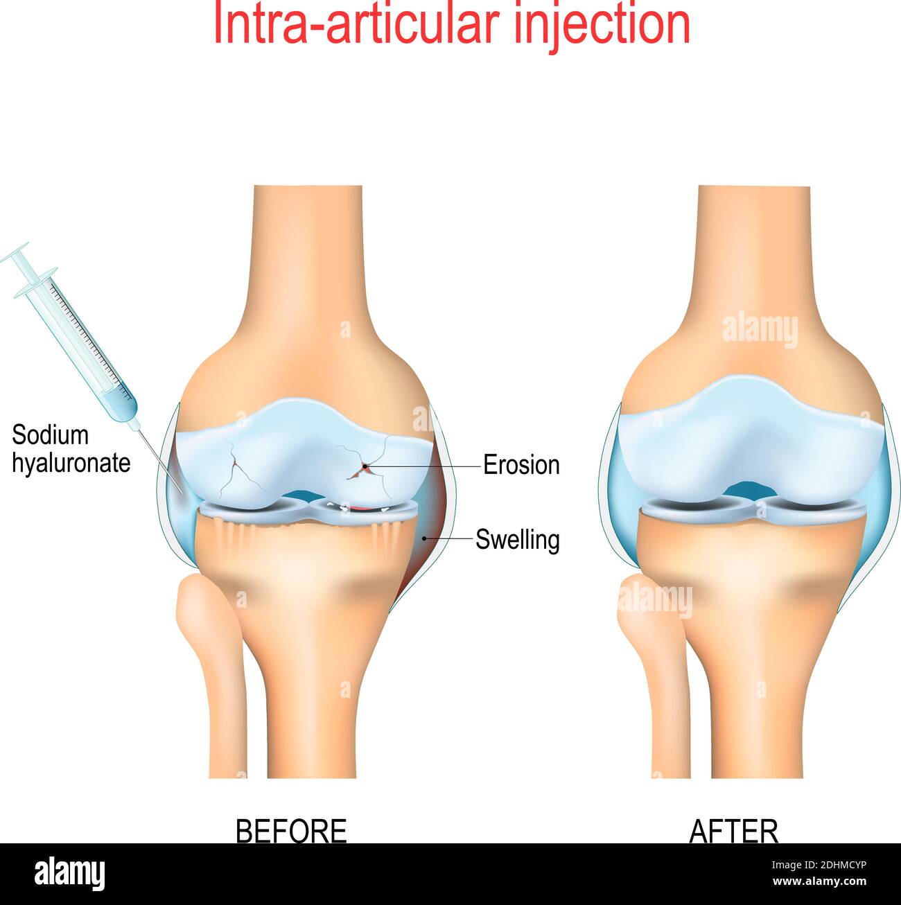Inyección de ácido hialurónico para la osteoartritis de rodilla.  Procedimiento médico. Eliminación del dolor de rodilla con inyecciones  Imagen Vector de stock - Alamy
