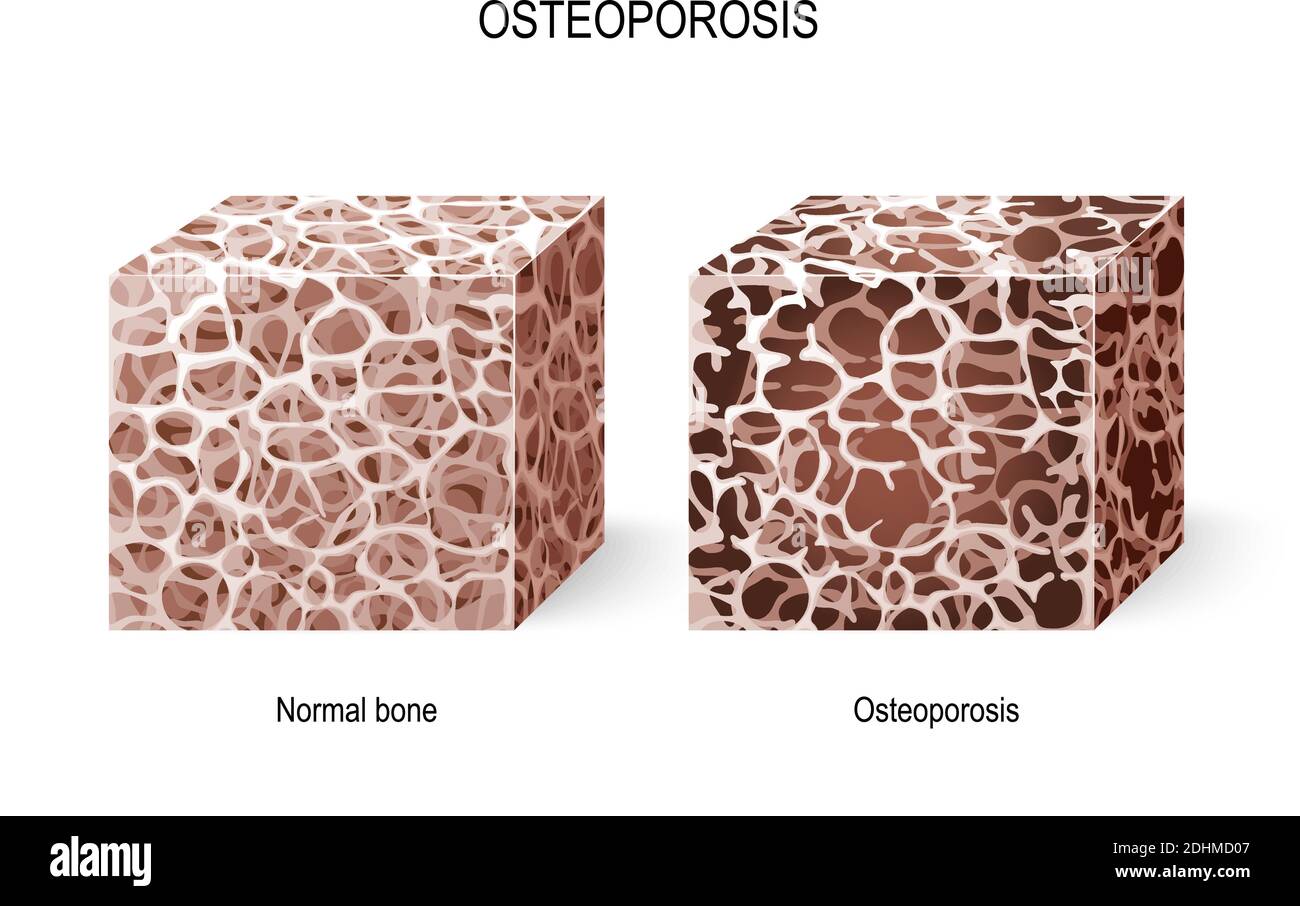Osteoporosis. Ilustración vectorial para su diseño y uso médico. Diferentes vistas de un tejido óseo (normal y osteoporosis). Enfermedad de los huesos Ilustración del Vector