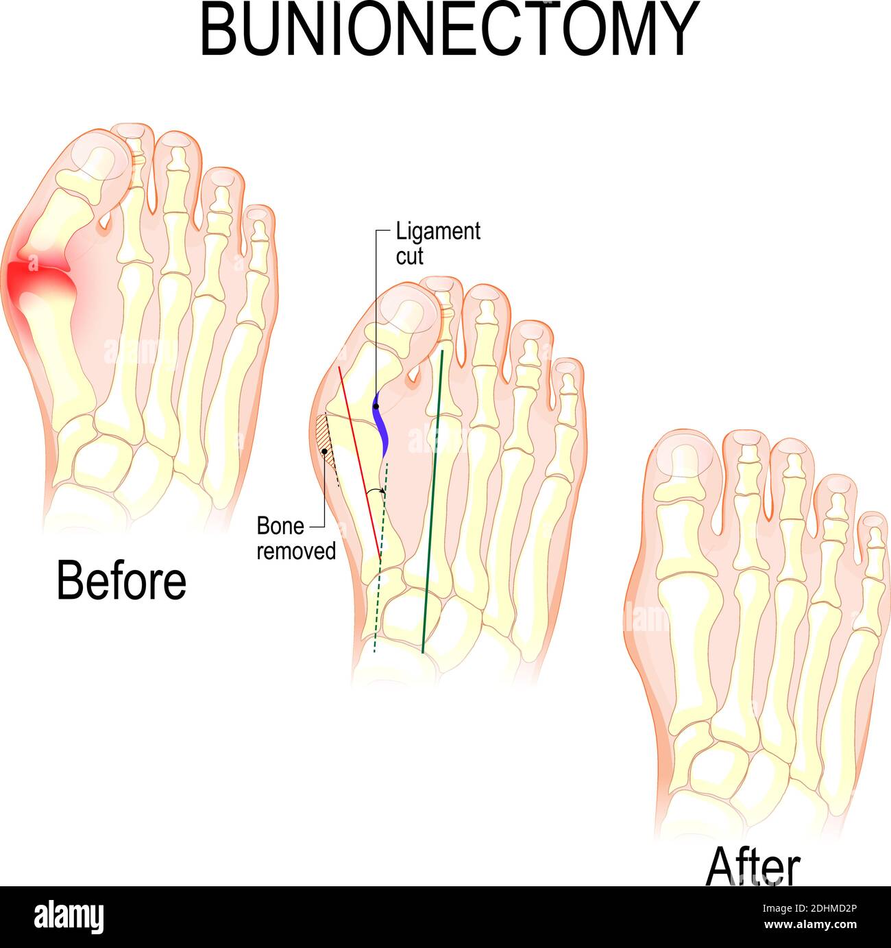 La bunionectomía es un procedimiento para corregir patologías y deformidades de la articulación que conecta el dedo gordo del pie con el pie. Antes y después de la cirugía Ilustración del Vector