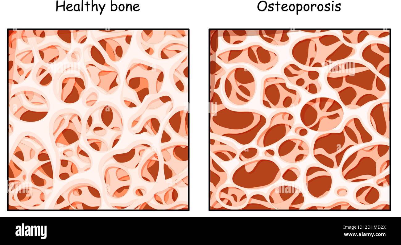 Huesos sanos y osteoporosis en comparación aislados sobre fondo blanco. Enfermedad de los huesos que conduce a un mayor riesgo de fractura. Baja densidad Ilustración del Vector