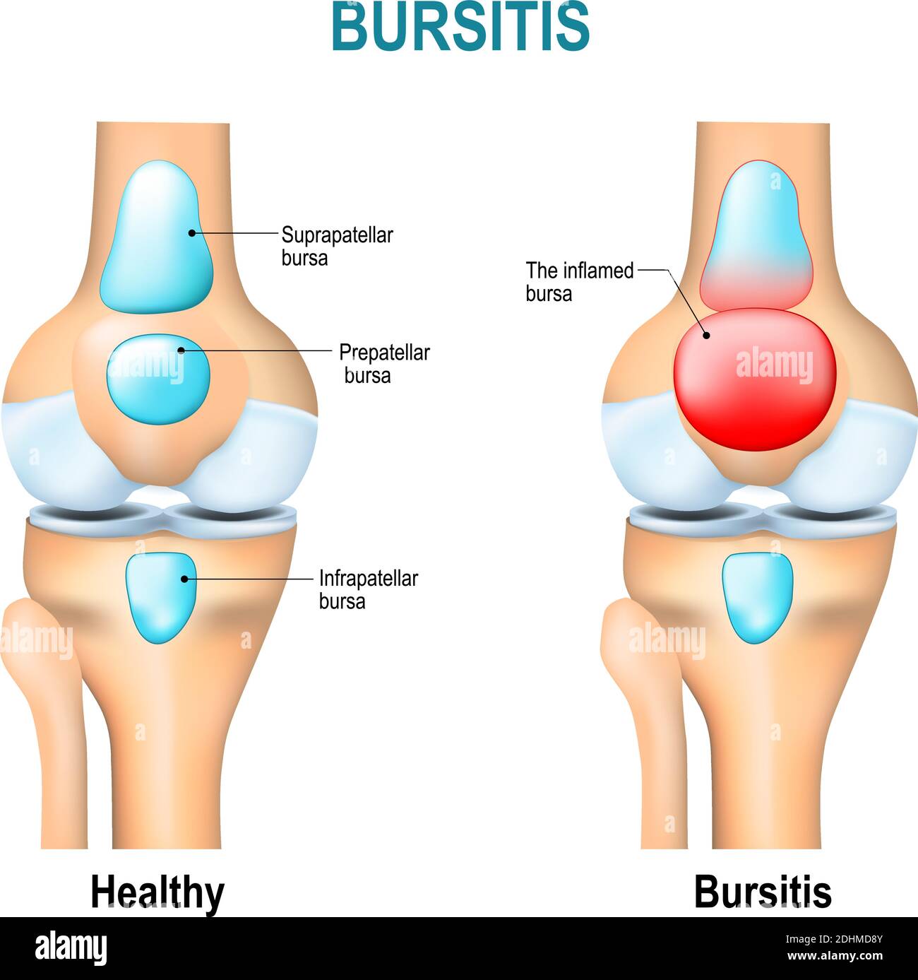 Bursitis. Rodilla y rodilla de humanos sanos con inflamación de las bursas (líquido sinovial). Ilustración del Vector