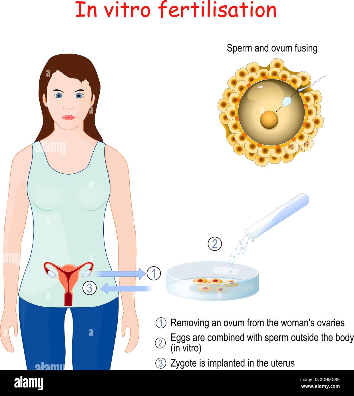 Fertilización in vitro (FIV). Primer plano de la fusión de esperma y óvulos. Extracción de un óvulo de los ovarios de la mujer Ilustración del Vector
