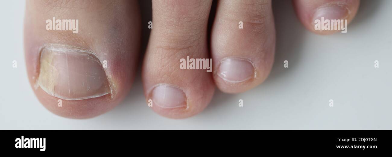 Micosis de punto amarillo en la uña del dedo gordo del pie closeup Foto de stock