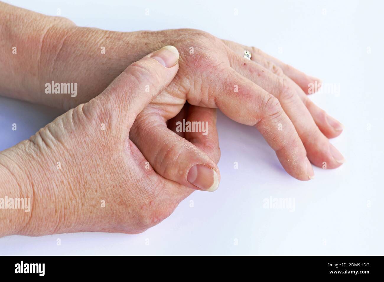 Una mujer tiene dolor en las manos y los dedos sufren de piel seca  Fotografía de stock - Alamy