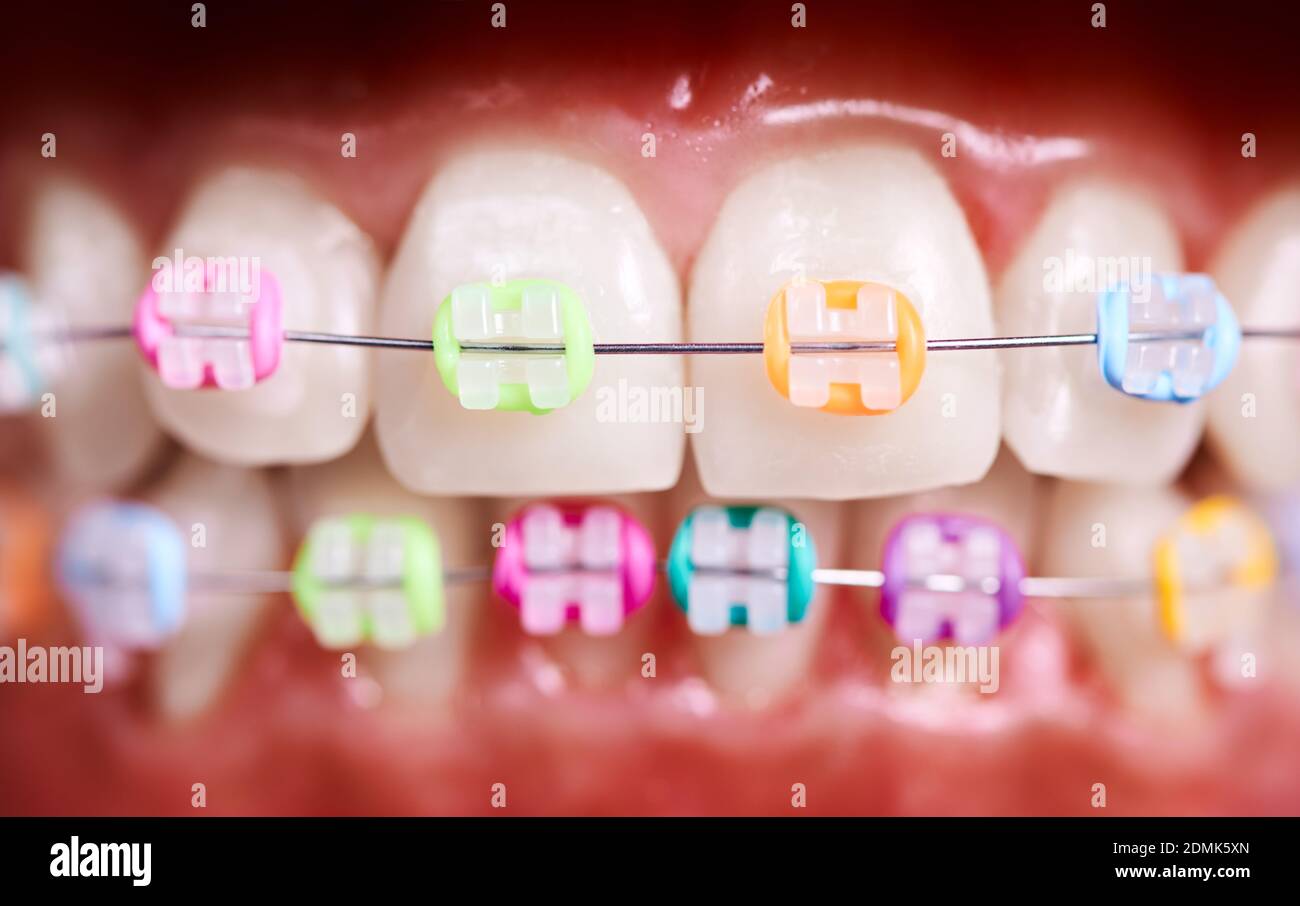 Primer plano de dientes blancos con abrazaderas ortodóncicas cableadas.  Paciente demostrando soportes dentales con bandas de goma multicolores.  Concepto de odontología, ort Fotografía de stock - Alamy